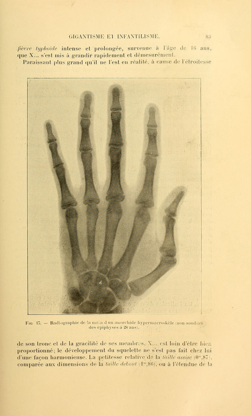 fièvre typhoule intense et prolongée, survenue à l'âge de 10 ans, que X... s'est mis à grandir rapidement et démesurément. Paraissant plus grand qu'il ne Test en réalité, à cause de létroilesse FiG i: Radiographie de la ma'.ii d un auorcliiiie liypermocroskèlc (non-sondiirc des épipliyses à 28 ans). de son tronc et de la gracilité de ses meniljrcs, X... est loin d'être bici; proportionné; le développement du squelette ne s'est pas lait chez lui d'une façon harmonieuse. La petitesse relative de la taille assise (0',(S7i, comparée aux dimensions de la taille debout (r,80), ou à l'étendue de la