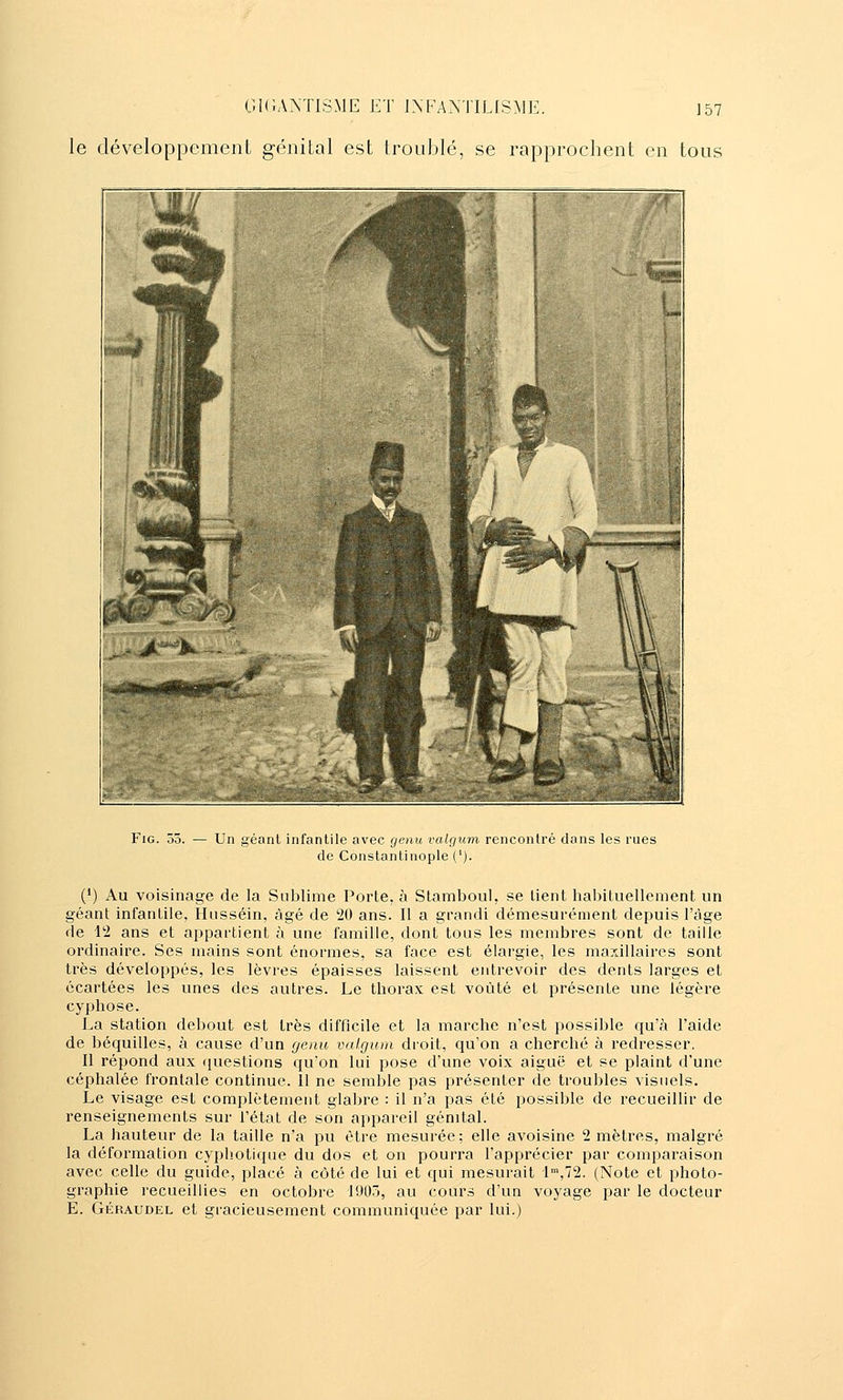 le développement génital est Iroulilé, se rapprochent en tous ^' m FiG. 53. Un géant infantile avec genu valgum rencontré dans les rues de Constantinople ('). (') Au voisinage de la Sublime Porte, à Stamboul, se lient habituellement un géant infantile, Hussein, âgé de '20 ans. Il a grandi démesurément depuis l'âge de 12 ans et appartient à une famille, dont tous les membres sont de taille ordinaire. Ses mains sont énormes, sa face est élargie, les maxillaires sont très développés, les lèvres épaisses laissent entrevoir des dents larges et écartées les unes des autres. Le thorax est voûté et présente une légère cyphose. La station debout est très difficile et la marche n'est possible qu'à l'aide de béquilles, à cause d'un genu valgum droit, qu'on a cherché à redresser. Il répond aux (juestions qu'on lui pose d'une voix aiguë et se plaint d'une céphalée frontale continue. 11 ne semble pas présenter de troubles visuels. Le visage est complètement glabre : il n'a pas été possible de recueillir de renseignements sur l'état de son appareil génital. La hauteur de la taille n'a pu être mesurée; elle avoisine 2 mètres, malgré la déformation cyphotique du dos et on pourra l'apprécier par comparaison avec celle du guide, placé à côté de lui et qui mesurait I\72. (Note et photo- graphie recueillies en octobre 1905, au cours d'un voyage par le docteur E. GÉRAUDEL et gracieusement communiquée par lui.)