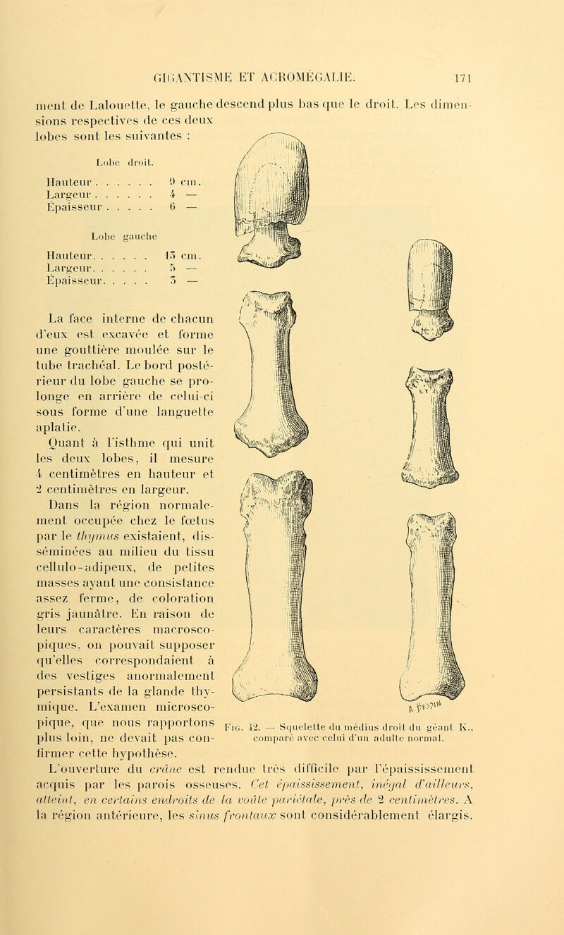 ment de Lalouette, le gauche descend plus basque le droit. Les dimen- sions respectives de ces deux lobes sont les suivantes : Lohe droit. Hauteur 9 cm. Largeur 4 — Épaisseur 6 — Lobe gauche Hauteur 13 cm. Largeur 5 — Épaisseur 5 — La face interne de chacun d'eux est excavée et forme une gouttière moulée sur le tube trachéal. Le bord posté- rieur du lobe gauche se pro- longe en arrière de celui-ci sous forme d'une languette aplatie. Quant à l'isthme qui unit les deux lobes, il mesure -4 centimètres en hauteur et '2 centimètres en largeur. Dans la région normale- ment occupée chez le fœtus par le thymus existaient, dis- séminées au milieu du tissu cellulo-adipeux, de petites masses ayant une consistance assez ferme, de coloration gris jaunâtre. En raison de leurs caractères macrosco- piques, on pouvait supposer qu'elles correspondaient à des vestiges anormalement persistants de la glande thy- mique. L'examen microsco- pique, c[ue nous rapportons plus loin, ne devait pas con- firmer cette hypothèse. L'ouverture du crâne est rendue très difficile par l'épaississement acquis par les parois osseuses. Cet épaississement, inégal d'ailleurs, atteint, en certains endroits de la voûte pariétale, près de 2 centimètres. A la région antérieure, les sinus frontaux sont considérablement élargis. FiG. ^.^^^'' 2. — Squelette du médius droit du géant K., comparé avec celui d'un adulte normal.