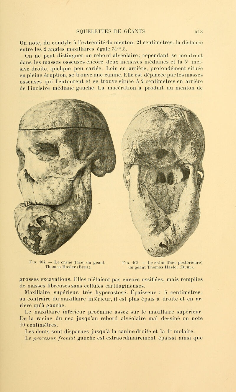 On note, du condyle à l'extrémité du menton, 21 centimètres; la distance entre les 2 angles maxillaires égale 51',5. On ne peut distinguer un rebord alvéolaire; cependant se montrent dans les masses osseuses encore deux incisives médianes et la 5° inci- sive droite, quelque peu cariée. Loin en arrière, profondément située en pleine éruption, se trouve une canine. Elle est déplacée par les masses osseuses qui l'entourent et se trouve située à 2 centimètres en arrière de l'incisive médiane gauche. La macération a produit au menton de F:g. lOi. — Le crâne (face) du géant Thomas Hasler (Buiir.). FiG. 103. — Le crâne (face postérieure) du géant Thomas Hasler (Buiil). grosses excavations. Elles n'étaient pas encore ossifiées, mais remplies de masses fibreuses sans cellules cartilagineuses. Maxillaire supérieur, très hyperostosé. Épaisseur : 5 centimètres; au contraire du maxillaire inférieur, il est plus épais à droite et en ar- rière qu'à gauche. Le maxillaire inférieur proémine assez sur le maxillaire supérieur. De la racine du nez jusqu'au rebord alvéolaire mal dessiné on note 10 centimètres. Les dents sont disparues jusqu'à la canine droite et la 1' molaire. Le processus frontal gauche est extraordinairement épaissi ainsi que