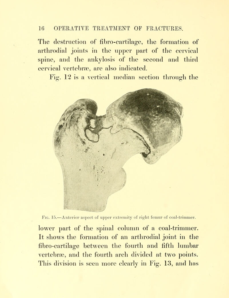 The destruction of fibro-cartilage, the formation of arthrodial joints in the upper part of the cervical spine, and the ankylosis of the second and third cervical vertebras, are also indicated. Fig-. 12 is a vertical median section through the Fig. 15.—Anterior aspect of upper extremity of right femur of coal-trimmer. lower part of the spinal column of a coal-trimmer. It shows the formation of an arthrodial joint in the fibro-cartilage between the fourth and fifth lumbar vertebrae, and the fourth arch divided at two points.