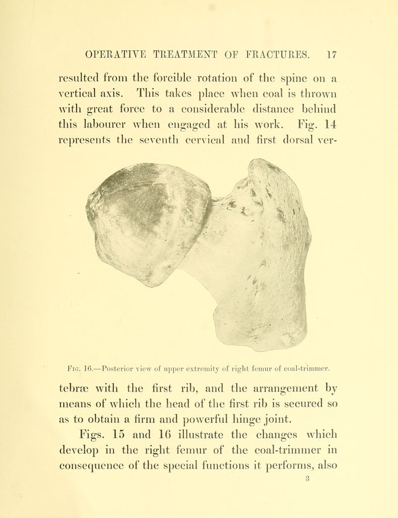 resulted from the forcible rotation of the spine on a vertical axis. This takes place when coal is thrown with great force to a considerable distance behind this labourer when engaged at his work. Fie;. 14 represents the seventh cervical and first dorsal ver- *k Fig. 16.—Posterior view of upper extremity of right femur of coal-trimmer. tebrae with the first rib, and the arrangement bv means of which the head of the first rib is secured so as to obtain a firm and powerful hinge joint. Figs. 15 and 16 illustrate the changes which develop in the right femur of the coal-trimmer in consequence of the special functions it performs, also