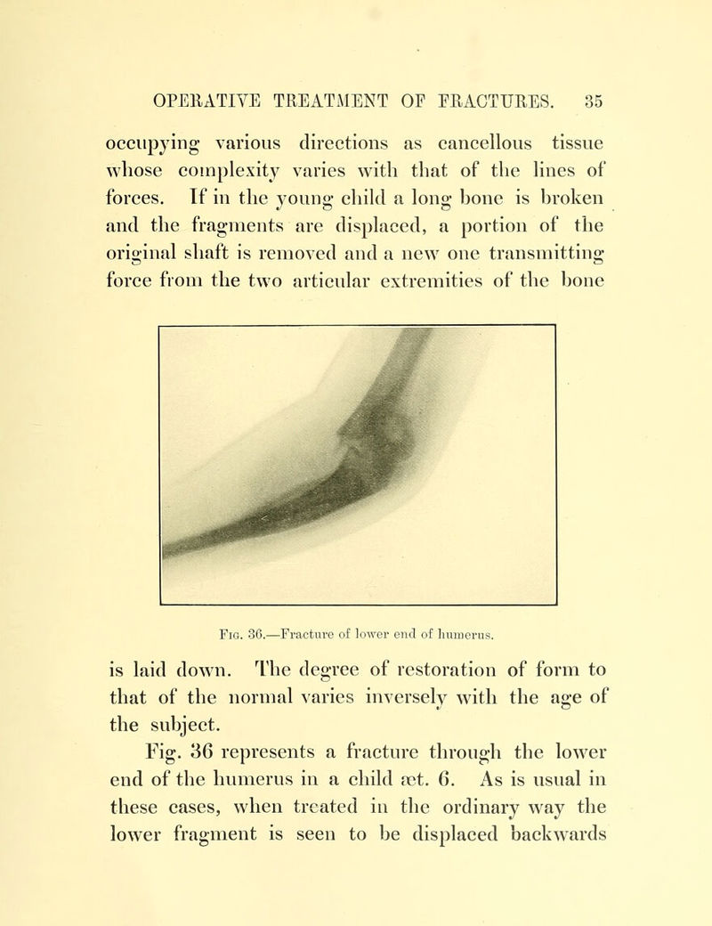 occupying various directions as cancellous tissue whose complexity varies with that of the lines of forces. If in the young child a long hone is broken and the fragments are displaced, a portion of the original shaft is removed and a new one transmitting force from the two articular extremities of the bone Fig. 36.—Fracture of lower end of humerus. is laid down. The degree of restoration of form to that of the normal varies inversely with the age of the subject. Fig. 36 represents a fracture through the lower end of the humerus in a child a3t. 6. As is usual in these cases, when treated in the ordinary way the lower fragment is seen to be displaced backwards