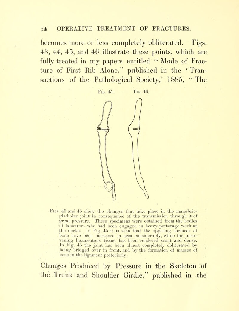 becomes more or less completely obliterated. Figs. 43, 44, 45, and 4G illustrate these points, which are fully treated in my papers entitled  Mode of Frac- ture of First Rib Alone, published in tbe ' Tran- sactions of the Pathological Society,' 1885,  The Fig. 45. Fig. 46. Figs. 45 and 46 show the changes that take place in the manubrio- gladiolar joint in consequence of the transmission through it of great pressure. These specimens were obtained from the bodies of labourers who had beeu engaged in heavy porterage work at the docks. In Fig. 45 it is seen that the opposing surfaces of bone have been increased in area considerably, while the inter- vening ligamentous tissue has been rendered scant and dense. In Fig. ,46 the joint has been almost completely obliterated by being bridged over in front, and by the formation of masses of bone in the ligament posteriorly. Changes Produced by Pressure in the Skeleton of the Trunk and Shoulder Girdle, published in the