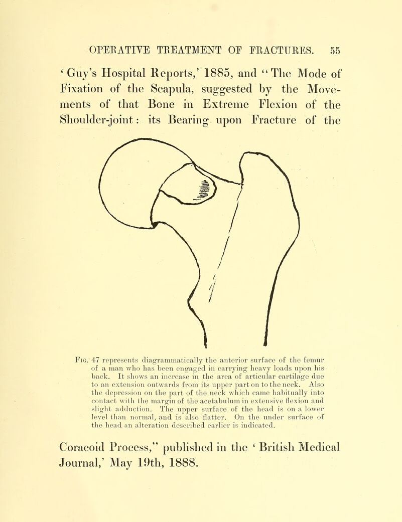 c Guy's Hospital Reports,' 1885, and The Mode of Fixation of the Scapula, suggested hy the Move- ments of that Bone in Extreme Flexion of the Shoulder-joint: its Bearing upon Fracture of the Fig. 47 represents diagrammatically tlie anterior surface of the femur of a man who has been engaged in carrying heavy loads upon liis • back. It shows an increase in the area of articular cartilage due to an extension outwards from its upper part on to the neck. Also the depression on the part of the neck which came habitually into contact with the margin of the acetabulum in extensive flexion and slight adduction. The upper surface of the head is on a lower level than normal, and is also flatter. On the under surface of the head an alteration described earlier is indicated. Coracoid Process, published in the ' British Medical Journal,' May 19th, 1888.