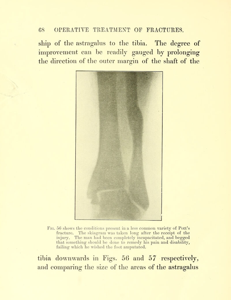 ship of the astragalus to the tibia. The degree of improvement can be readily gauged by prolonging the direction of the outer margin of the shaft of the Fig. 56 shows the conditions present in a less common variety of Pott's fracture. The skiagram was taken long after the receipt of the injury. The man had been completely incapacitated, and begged that something should be done to remedy his pain and disability, failing which he wished the foot amputated. tibia downwards in Figs. 56 and 57 respectively, and comparing the size of the areas of the astragalus