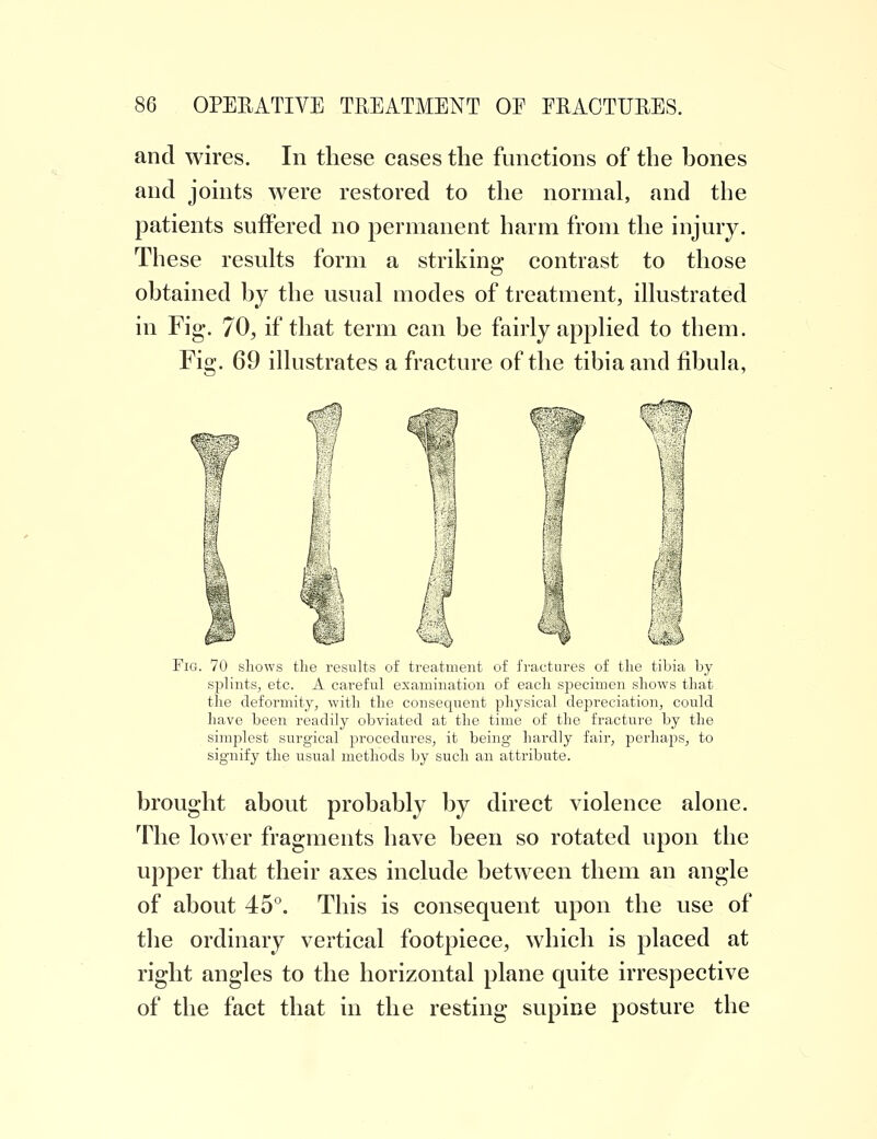 and wires. In these cases the functions of the bones and joints were restored to the normal, and the patients suffered no permanent harm from the injury. These results form a striking contrast to those obtained by the usual modes of treatment, illustrated in Fig. 70, if that term can be fairly applied to them. Fig. 69 illustrates a fracture of the tibia and fibula, ■m Fig. 70 shows the results of treatment of fractures of the tibia by splints, etc. A careful examination of each specimen shows that the deformity, with the consequent physical depreciation, could have been readily obviated at the time of the fracture by the simplest surgical procedures, it being hardly fair, perhaps, to signify the usual methods by such an attribute. brought about probably by direct violence alone. The lower fragments have been so rotated upon the upper that their axes include between them an angle of about 45°. This is consequent upon the use of the ordinary vertical footpiece, which is placed at right angles to the horizontal plane quite irrespective of the fact that in the resting supine posture the