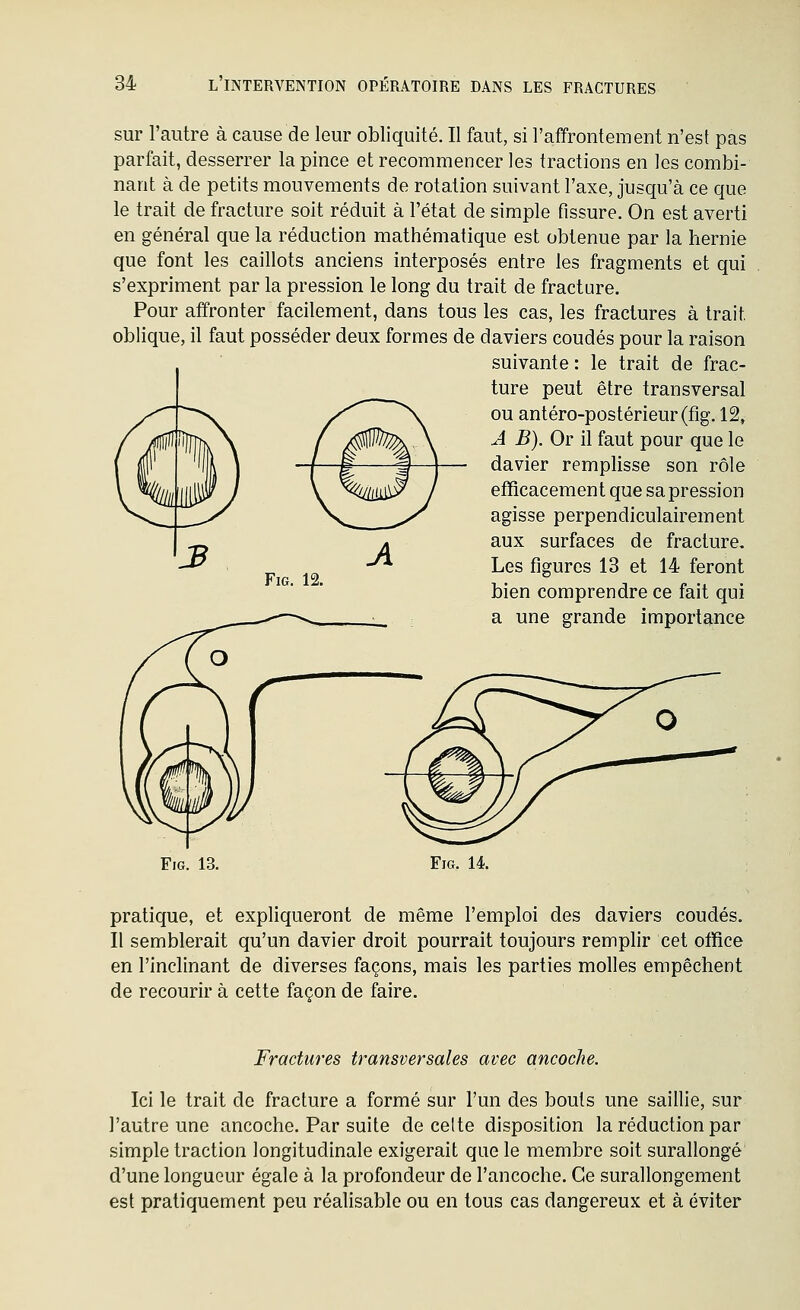 sur l'autre à cause de leur obliquité. Il faut, si l'affrontement n'est pas parfait, desserrer la pince et recommencer les tractions en les combi- nant à de petits mouvements de rotation suivant l'axe, jusqu'à ce que le trait de fracture soit réduit à l'état de simple fissure. On est averti en général que la réduction mathématique est obtenue par la hernie que font les caillots anciens interposés entre les fragments et qui s'expriment par la pression le long du trait de fracture. Pour affronter facilement, dans tous les cas, les fractures à trait oblique, il faut posséder deux formes de daviers coudés pour la raison suivante: le trait de frac- ture peut être transversal ou antéro-postérieur(fig. 12, A B). Or il faut pour que le davier remplisse son rôle efïicacement que sa pression agisse perpendiculairement aux surfaces de fracture. Les figures 13 et 14 feront FiG 12 bien comprendre ce fait qui a une grande importance FiG. 14. pratique, et expliqueront de même l'emploi des daviers coudés. Il semblerait qu'un davier droit pourrait toujours remplir cet office en l'inclinant de diverses façons, mais les parties molles empêchent de recourir à cette façon de faire. Fractures transversales avec ancoche. Ici le trait de fracture a formé sur l'un des bouts une saillie, sur l'autre une ancoche. Par suite de celte disposition la réduction par simple traction longitudinale exigerait que le membre soit surallongé d'une longueur égale à la profondeur de l'ancoche. Ce surallongement est pratiquement peu réalisable ou en tous cas dangereux et à éviter