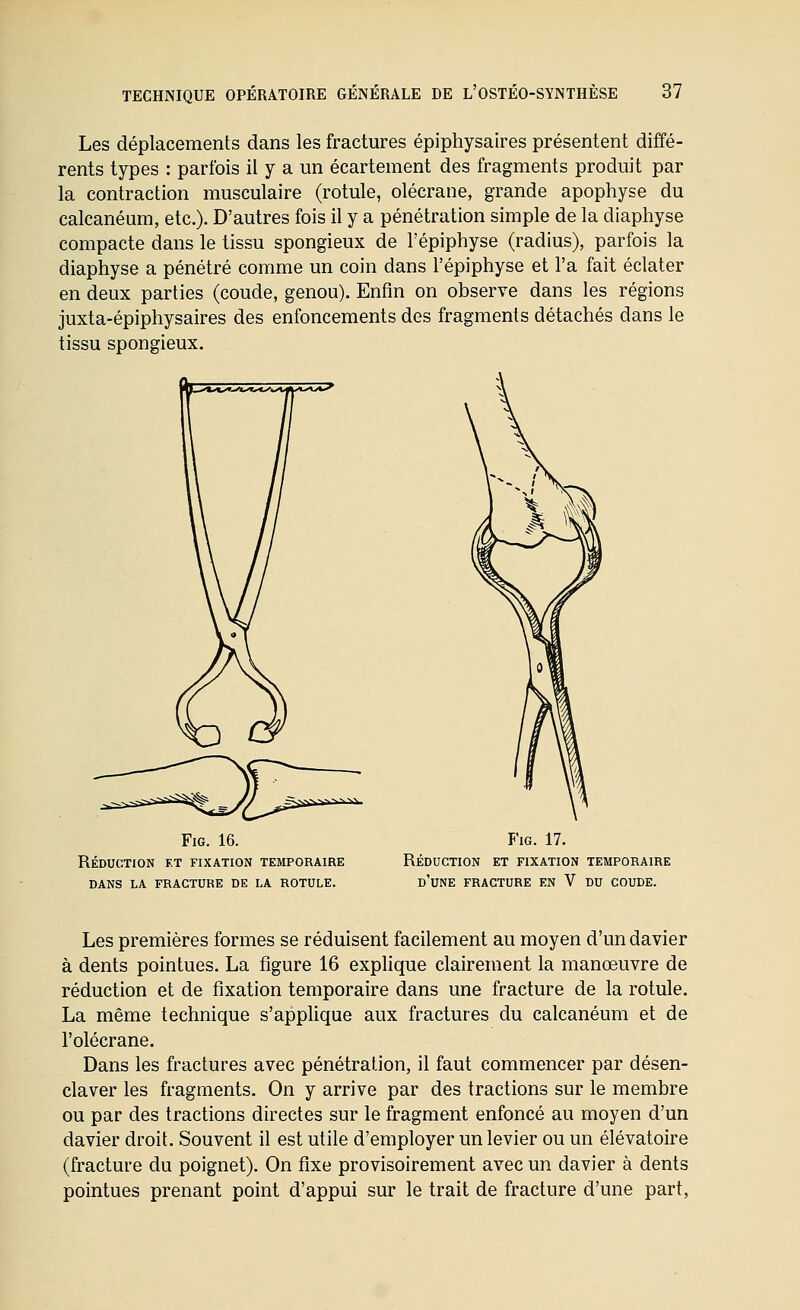 Les déplacements dans les fractures épiphysaires présentent diffé- rents types : parfois il y a un écartement des fragments produit par la contraction musculaire (rotule, olécrane, grande apophyse du calcanéum, etc.). D'autres fois il y a pénétration simple de la diaphyse compacte dans le tissu spongieux de l'épiphyse (radius), parfois la diaphyse a pénétré comme un coin dans l'épiphyse et l'a fait éclater en deux parties (coude, genou). Enfin on observe dans les régions juxta-épiphysaires des enfoncements des fragments détachés dans le tissu spongieux. FiG. 16. Réduction et fixation temporaire dans la fracture de la rotule. FiG. 17. Réduction et fixation temporaire d'une fracture EN V DU COUDE. Les premières formes se réduisent facilement au moyen d'un davier à dents pointues. La figure 16 explique clairement la manœuvre de réduction et de fixation temporaire dans une fracture de la rotule. La même technique s'applique aux fractures du calcanéum et de l'olécrane. Dans les fractures avec pénétration, il faut commencer par désen- claver les fragments. On y arrive par des tractions sur le membre ou par des tractions directes sur le fragment enfoncé au moyen d'un davier droit. Souvent il est utile d'employer un levier ou un élévatoire (fracture du poignet). On fixe provisoirement avec un davier à dents pointues prenant point d'appui sur le trait de fracture d'une part,