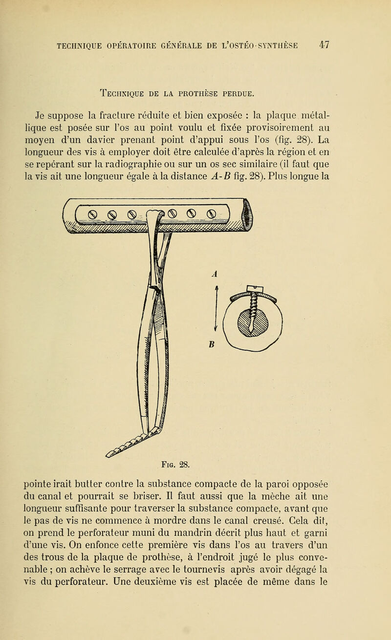 Technique de la prothèse perdue. Je suppose la fracture réduite et bien exposée : la plaque métal- lique est posée sur l'os au point voulu et fixée provisoirement au moyen d'un davier prenant point d'appui sous l'os (fig. 28). La longueur des vis à employer doit être calculée d'après la région et en se repérant sur la radiographie ou sur un os sec similaire (il faut que la vis ait une longueur égale à la distance A-B fig. 28). Plus longue la Fig. 28. pointe irait butter contre la substance compacte de la paroi opposée du canal et pourrait se briser. Il faut aussi que la mèche ait une longueur suffisante pour traverser la substance compacte, avant que le pas de vis ne commence à mordre dans le canal creusé. Cela dit, on prend le perforateur muni du mandrin décrit plus haut et garni d'une vis. On enfonce cette première vis dans l'os au travers d'un des trous de la plaque de prothèse, à l'endroit jugé le plus conve- nable ; on achève le serrage avec le tournevis après avoir dégagé la vis du perforateur. Une deuxième vis est placée de même dans le