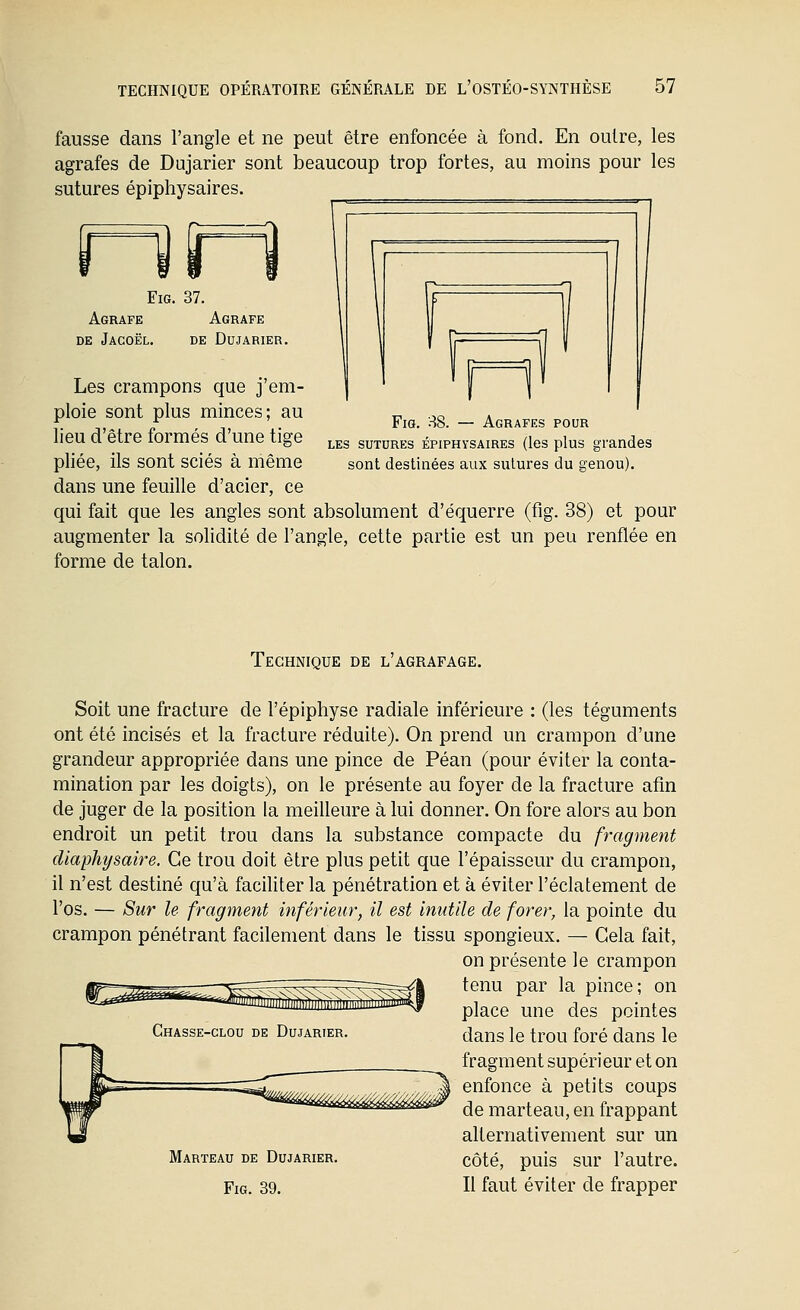 fausse dans l'angle et ne peut être enfoncée à fond. En outre, les agrafes de Dujarier sont beaucoup trop fortes, au moins pour les sutures épiphysaires. FiG. 37. Agrafe Agrafe DE Jacoël. de Dujarier. n Fia. 38. — Agrafes pour LES SUTURES ÉPIPHYSAIRES (les plus grandes sont destinées aux sutures du genou). Les crampons que j'em- ploie sont plus minces; au lieu d'être formés d'une tige pliée, ils sont sciés à même dans une feuille d'acier, ce qui fait que les angles sont absolument d'équerre (fig. 38) et pour augmenter la solidité de l'angle, cette partie est un peu renflée en forme de talon. Technique de l'agrafage. Soit une fracture de l'épiphyse radiale inférieure : (les téguments ont été incisés et la fracture réduite). On prend un crampon d'une grandeur appropriée dans une pince de Péan (pour éviter la conta- mination par les doigts), on le présente au foyer de la fracture afin de juger de la position la meilleure à lui donner. On fore alors au bon endroit un petit trou dans la substance compacte du fragment cUaphysaire. Ce trou doit être plus petit que l'épaisseur du crampon, il n'est destiné qu'à faciliter la pénétration et à éviter l'éclatement de l'os. — Sur le fragment inférieur, il est Inutile de forer, la pointe du crampon pénétrant facilement dans le tissu spongieux. — Gela fait, on présente le crampon tenu par la pince; on place une des pointes dans le trou foré dans le fragment supérieur et on enfonce à petits coups de marteau, en frappant alternativement sur un Marteau de Dujarier. côté, puis sur l'autre. Fig. 39. Il faut éviter de frapper