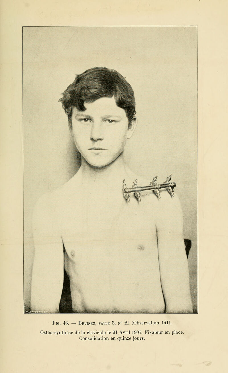 FiG. 46. — Bruinen, salle 5, n° 21 (Observation 141). Ostéo-synthèse de la clavicule le 21 Avril 1905. Fixateur en place. Consolidation en quinze jours.
