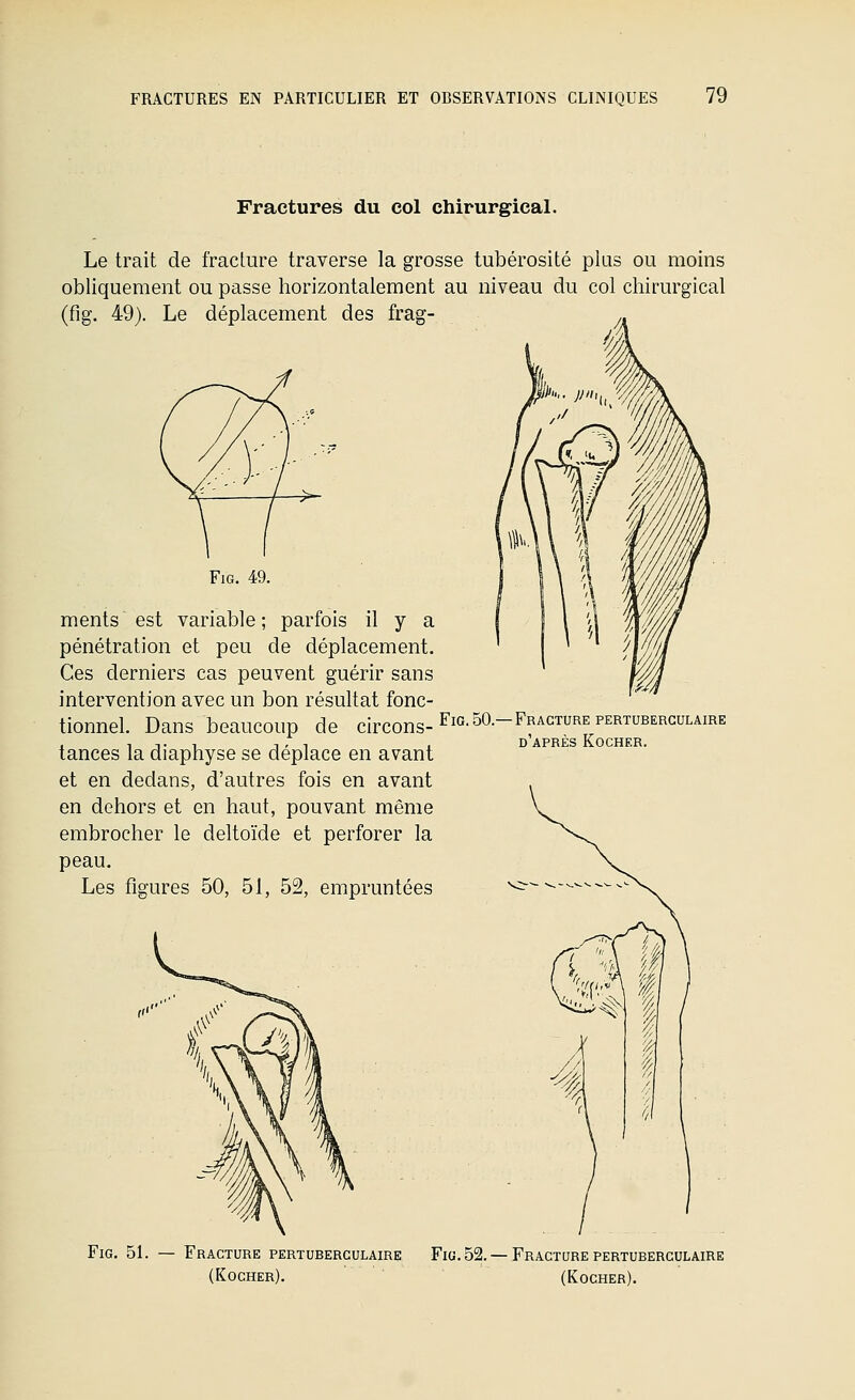 Fractures du col chirurgical. Le trait de fracture traverse la grosse tubérosité plus ou moins obliquement ou passe horizontalement au niveau du col chirurgical (fig. 49). Le déplacement des frag- FiG. 49. ments est variable ; parfois il y a pénétration et peu de déplacement. Ces derniers cas peuvent guérir sans intervention avec un bon résultat fonc- tionnel. Dans beaucoup de circons-^'«■SO--f^«^^™^^^^^™^'^<'^^^'^^ . 1 T 1 1-1 1 d'après Kocher. tances la diaphyse se déplace en avant et en dedans, d'autres fois en avant en dehors et en haut, pouvant même embrocher le deltoïde et perforer la peau. Les figures 50, 51, 52, empruntées Fig, 51. — Fracture pertuberculaire (Kocher). Fig. 52. Fracture pertuberculaire (Kocher).