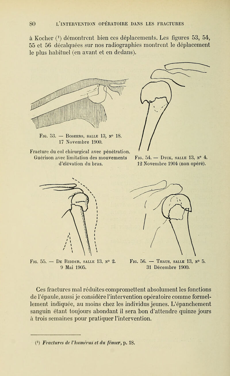 à Kocher (') démontrent bien ces déplacements. Les figures 53, 54, 55 et 56 décalquées sur nos radiographies montrent le déplacement le plus habituel (en avant et en dedans). FiG. 53. — BOSEERS, SALLE 13, N» 18. 17 Novembre 1900. Fracture du col chirurgical avec pénétration, Guérison avec limitation des mouvements Fig. 54. — Dyck, salle 13, n 4. d'élévation du bras. 12 Novembre 1904 (non opéré). Fig. 55. — De Ridder, salle 13, n° 2. 9 Mai 1905. Fig. 56. — Thaus, salle 13, n° 5. 31 Décembre 1900. Ces fractures mal réduites compromettent absolument les fonctions de l'épaule, aussi je considère l'intervention opératoire comme formel- lement indiquée, au moins chez les individus jeunes. L'épanchement sanguin étant toujours abondant il sera bon d'attendre quinze jours à trois semaines pour pratiquer l'intervention.