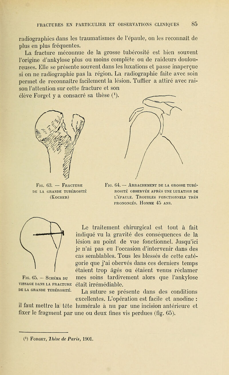 radiographies dans les traumatismes de l'épaule, on les reconnaît de plus en plus fréquentes. La fracture méconnue de la grosse tubérosité est bien souvent l'origine d'ankylose plus ou moins complète ou de raideurs doulou- reuses. Elle se présente souvent dans les luxations et passe inaperçue si on ne radiographie pas la région. La radiographie faite avec soin permet de reconnaître facilement la lésion. TufRer a attiré avec rai- son l'attention sur cette fracture et son élève Forget y a consacré sa thèse Q). ■-^ FiG. 63. — Fracture de la grande tubérosité (Rocher) FiG. 64. — Arrachement de la grosse tubé- rosité OBSERVÉE APRÈS UNE LUXATION DE 1,'ÉPAULE. Troubles fonctionnels très PRONONCÉS. Homme 45 ans. Le traitement chirurgical est tout à fait indiqué vu la gravité des conséquences de la lésion au point de vue fonctionnel. Jusqu'ici je n'ai pas eu l'occasion d'intervenir dans des cas semblables. Tous les blessés de cette caté- gorie que j'ai obervés dans ces derniers temps étaient trop âgés ou étaient venus réclamer mes soins tardivement alors que l'ankylose était irrémédiable. La suture se présente dans des conditions excellentes. L'opération est facile et anodine : il faut mettre la tête humérale à nu par une incision antérieure et fixer le fragment par une ou deux fines vis perdues (fig. 65). FiG. 65. — Schéma du vissage dans la FRACTURE DE LA GRANDE TUBÉROSITÉ. (1) FoRGET, Ihèse de Paris, 1901.