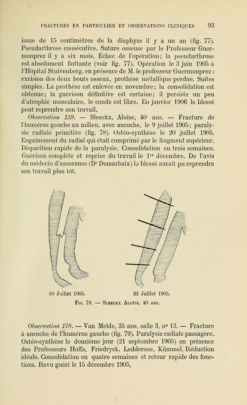 issue de 15 centimètres de la diaphyse il y a un an (flg. 77). Pseudarthrose consécutive. Suture osseuse par le Professeur Guer- monprez il y a six mois. Échec de l'opération; la pseudarthrose est absolument flottante (voir fig. 77). Opération le 3 juin 1905 à l'Hôpital Stuivenberg, en présence de M. le professeur Guermonprez : excision des deux bouts osseux, prothèse métallique perdue. Suites simples. La prothèse est enlevée en novembre ; la consolidation est obtenue; la guérison définitive est certaine; il persiste un peu d'atrophie musculaire, le coude est hbre. En janvier 1906 le blessé peut reprendre son travail. Observation 159. — Sleeckx, Aloïse, 40 ans. — Fracture de l'humérus gauche au milieu, avec ancoche, le 9 juillet 1905 ; paraly- sie radiale primitive (fig. 78). Ostéo-synthèse le 20 juillet 1905. Engainement du radial qui était comprimé par le fragment supérieur. Disparition rapide de la paralysie. Consolidation en trois semaines. Guérison complète et reprise du travail le l*'' décembre. De l'avis du médecin d'assurance (D' Demarbaix) le blessé aurait pu reprendre son travail plus tôt. 10 Juillet 1905. 22 Juillet 1905. Fig. 78. — Sleeckx Aloïse, 40 ans. Observation 178. — Van Melde, 35 ans, salle 3, n 13. — Fracture à ancoche de l'humérus gauche (fig. 79). Paralysie radiale passagère. Ostéo-synthèse le douzième jour (21 septembre 1905) en présence des Professeurs Hoffa, Friedryck, Ledderose, Kûmmel. Réduction idéale. Consolidation en quatre semaines et retour rapide des fonc- tions. Revu guéri le 15 décembre 1905,