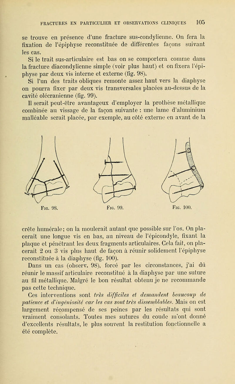 se trouve en présence d'une fracture sus-condylienne. On fera la fixation de l'épiphyse reconstituée de différentes façons suivant les cas. Si le trait sus-articulaire est bas on se comportera comme dans la fracture diacondylienne simple (voir plus haut) et on fixera l'épi- physe par deux vis interne et externe (fig. 98). Si l'un des traits obliques remonte assez haut vers la diaphyse on pourra fixer par deux vis transversales placées au-dessus de la cavité olécranienne (fig. 99). Il serait peut-être avantageux d'employer la prothèse métallique combinée au vissage de la façon suivante : une lame d'aluminium malléable serait placée, par exemple, au côté externe en avant de la Fig. 9S. Fig. 99. Fig. 100. crête humérale ; on la moulerait autant que possible sur l'os. On pla- cerait une longue vis en bas, au niveau de l'épicondyle, fixant la plaque et pénétrant les deux fragments articulaires. Gela fait, on pla- cerait 2 ou 3 vis plus haut de façon à réunir solidement l'épiphyse reconstituée à la diaphyse (fig. 100). Dans un cas (observ. 98), forcé par les circonstances, j'ai dû réunir le massif articulaire reconstitué à la diaphyse par une suture au fil métallique. Malgré le bon résultat obtenu je ne recommande pas cette technique. Ces interventions sont très difficiles et demandent beaucoup de 2)atience et d'ingéniosité car les cas sont très dissemblables. Mais on est largement récompensé de ses peines par les résultats qui sont vraiment consolants. Toutes mes sutures du coude m'ont donné d'excellents résultats, le plus souvent la restitution fonctionnelle a été complète.