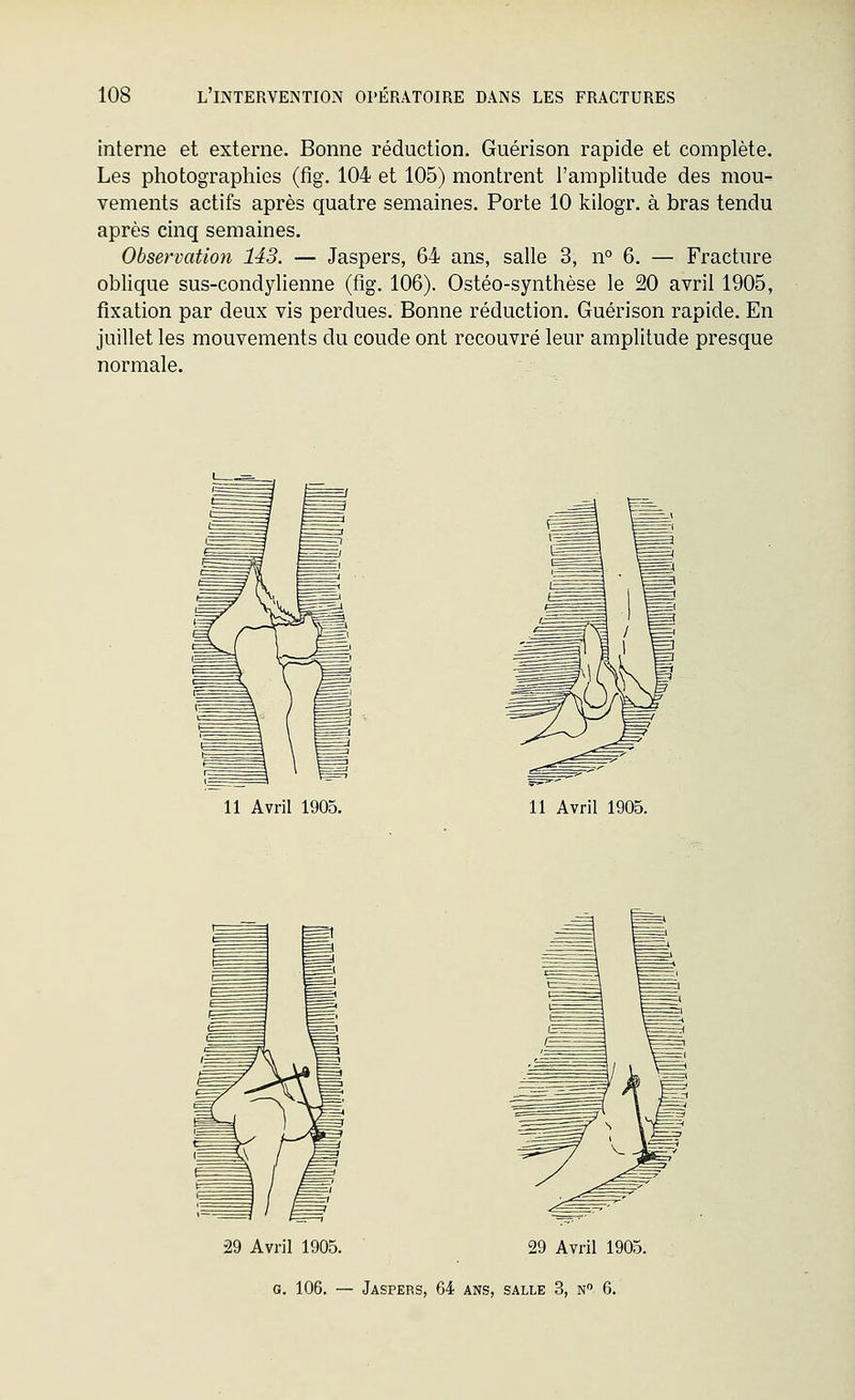 interne et externe. Bonne réduction. Guérison rapide et complète. Les photographies (fig. 104 et 105) montrent l'amplitude des mou- vements actifs après quatre semaines. Porte 10 kilogr. à bras tendu après cinq semaines. Observation 143. — Jaspers, 64 ans, salle 3, n° 6. — Fracture oblique sus-condylienne (fig. 106). Ostéo-synthèse le 20 avril 1905, fixation par deux vis perdues. Bonne réduction. Guérison rapide. En juillet les mouvements du coude ont recouvré leur amplitude presque normale. 11 Avril 1905, 11 Avril 1905. 29 Avril 1905, 29 Avril 1905.