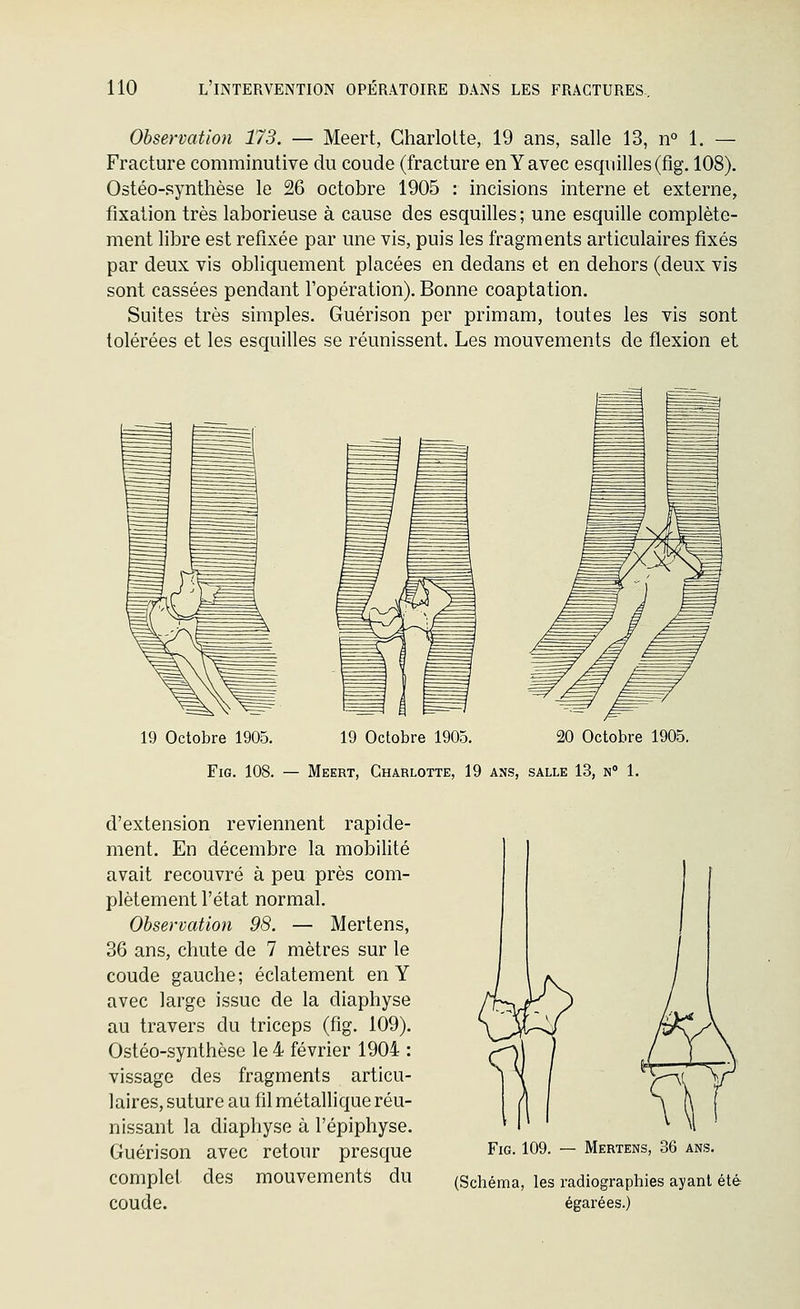 Observation 173. — Meert, GharloUe, 19 ans, salle 13, n° 1. — Fracture comminutive du coude (fracture en Y avec esquilles (flg, 108). Ostéo-synthèse le 26 octobre 1905 : incisions interne et externe, fixation très laborieuse à cause des esquilles ; une esquille complète- ment libre est refixée par une vis, puis les fragments articulaires fixés par deux vis obliquement placées en dedans et en dehors (deux vis sont cassées pendant l'opération). Bonne coaptation. Suites très simples. Guérison per primam, toutes les vis sont tolérées et les esquilles se réunissent. Les mouvements de flexion et 19 Octobre 1905. 19 Octobre 1905. 20 Octobre 1905. FiG. 108. — Meert, Charlotte, 19 ans, salle 13, n 1. d'extension reviennent rapide- ment. En décembre la mobilité avait recouvré à peu près com- plètement l'état normal. Observation 98. — Mertens, 36 ans, chute de 7 mètres sur le coude gauche; éclatement en Y avec large issue de la diaphyse au travers du triceps (fig. 109). Ostéo-synthèse le 4 février 1904 : vissage des fragments articu- laires, suture au fil métallique réu- nissant la diaphyse à l'épiphyse. Guérison avec retour presque complet des mouvements du coude. Fig. 109. — Mertens, 36 ans. (Schéma, les radiographies ayant été égarées.)