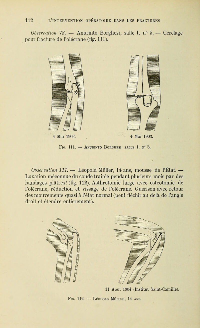 Ohsercation 13. — Anurinto Borghesi, salle 1, n° 5. — Cerclage pour fracture de l'olécrane (fig. 111). 4 Mai 1903. . 4 Mai 1903. FiG. 111. — Anurinto Borghesi, salle 1, n° 5. Observation 111. — Léopold MûUer, 14 ans, mousse de l'État. — Luxation méconnue du coude traitée pendant plusieurs mois par des bandages plâtrés! (fig. 112). Asthrotomie large avec ostéotomie de l'olécrane, réduction et vissage de l'olécrane. Guérison avec retour des mouvements quasi à l'état normal (peut fléchir au delà de l'angle droit et étendre entièrement). 11 Août 1904 (Institut Saint-Camille). Fig. 112. — Léopold Mûllèb, 14 ans.