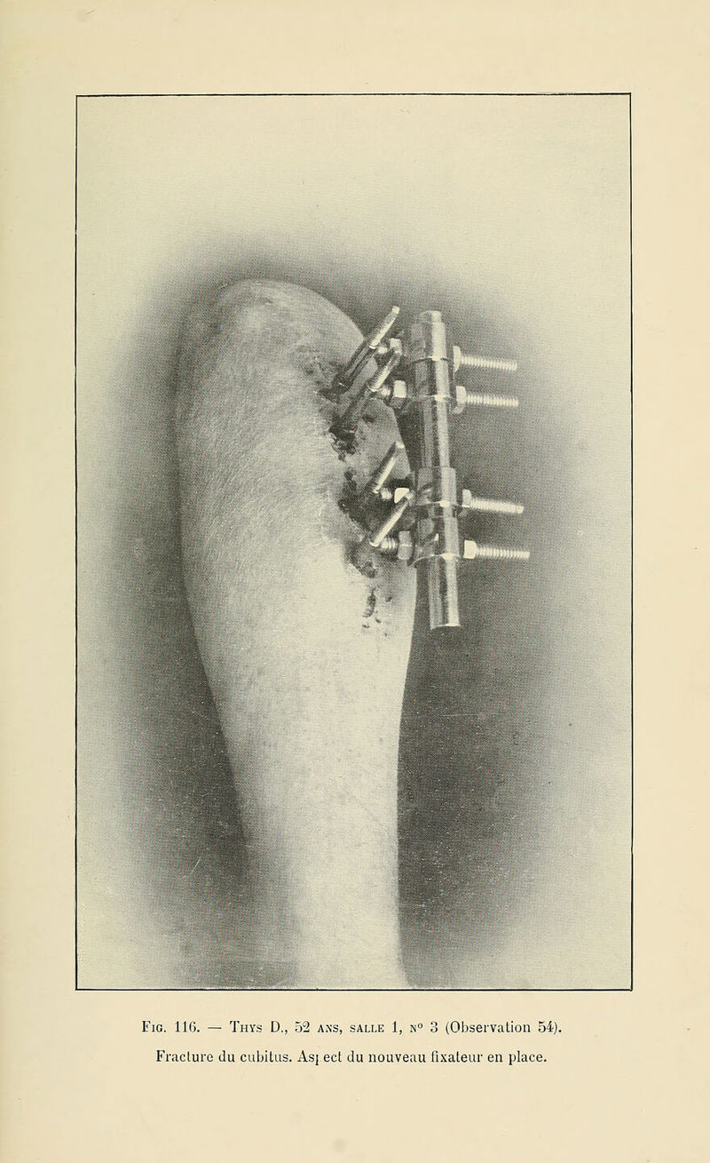 Fracture du cubitus. As{ ect du nouveau fixateur en place.