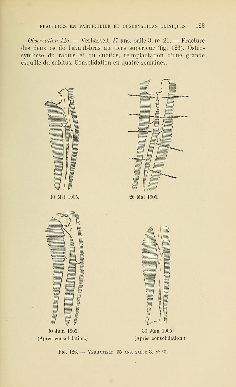 Observation 148. — Verhasselt, 35 ans, salle 3, n° 21. — Fracture des deux os de l'avant-bras au tiers supérieur (fig. 126). Ostéo- synthèse du radius et du cubitus, réimplantatiori d'une grande esquille du cubitus. Consolidation en quatre semaines. rV 10 Mai 1905. 26 Mai 1905. 30 Juin 1905. (Après consolidation.) 30 Juin 1905. (Après consolidation.)