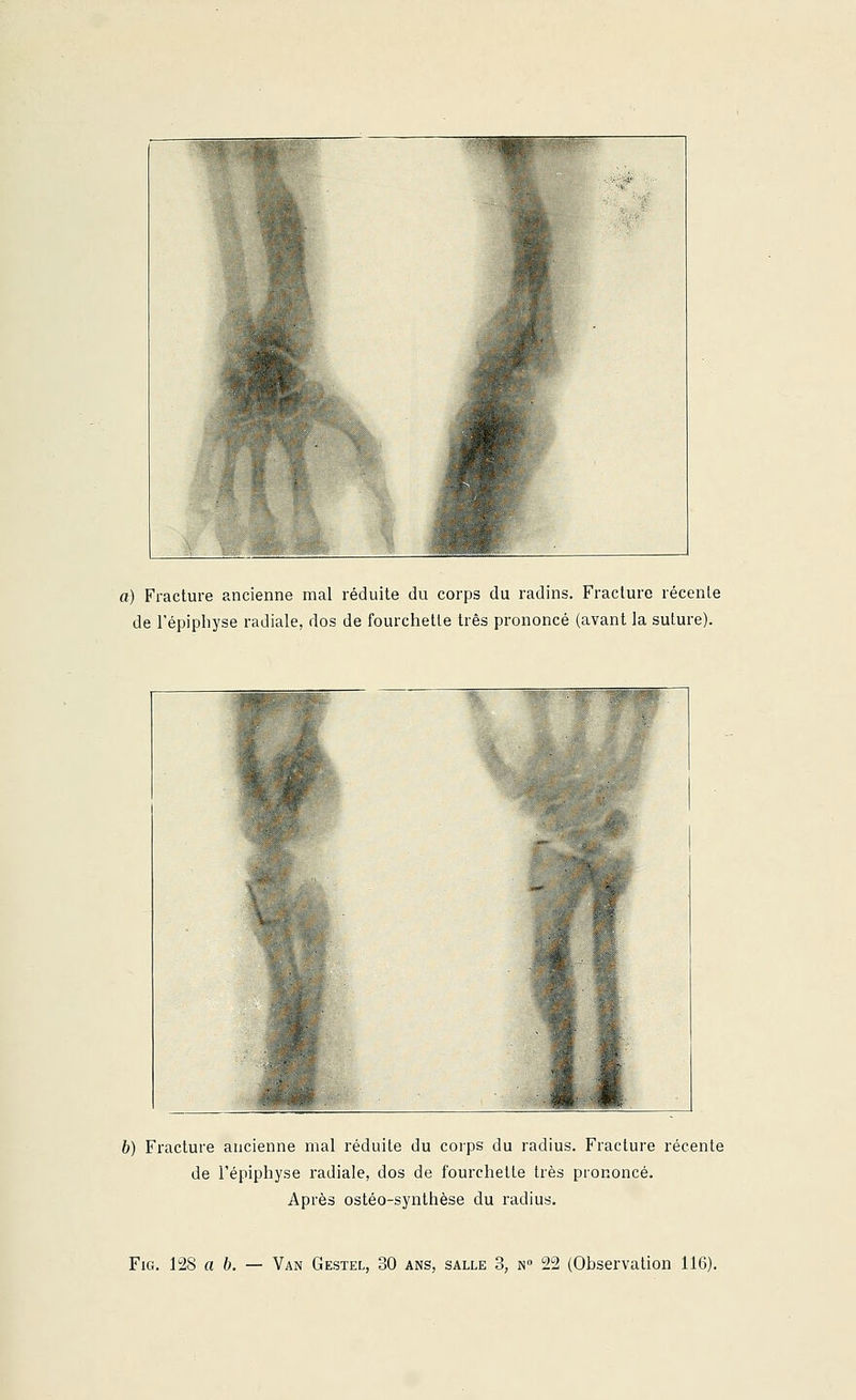 a) Fracture ancienne mal réduite du corps du radins. Fracture récente de l'épiphyse radiale, dos de fourchette très prononcé (avant la suture). 6) Fracture ancienne niai réduite du corps du radius. Fracture récente de l'épiphyse radiale, dos de fourchette très prononcé. Après ostéo-synthèse du radius.