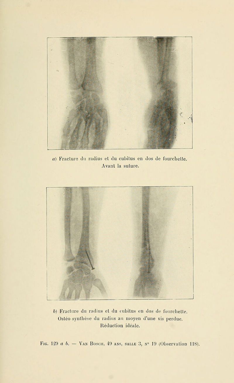 a) Fracture du radius et du cubitus en dos de fourchette. Avant la suture. 6) Fracture du radius et du cubitus en dos de fourchette. Osléo synthèse du radius au moyen d'une vis perdue. Réduction idéale.