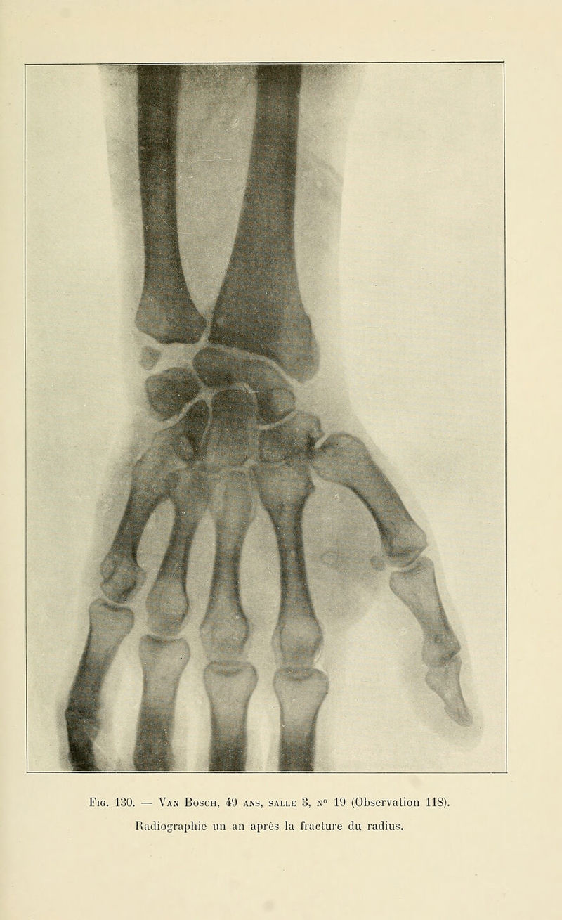 Radiographie un an après la fracture du radius.