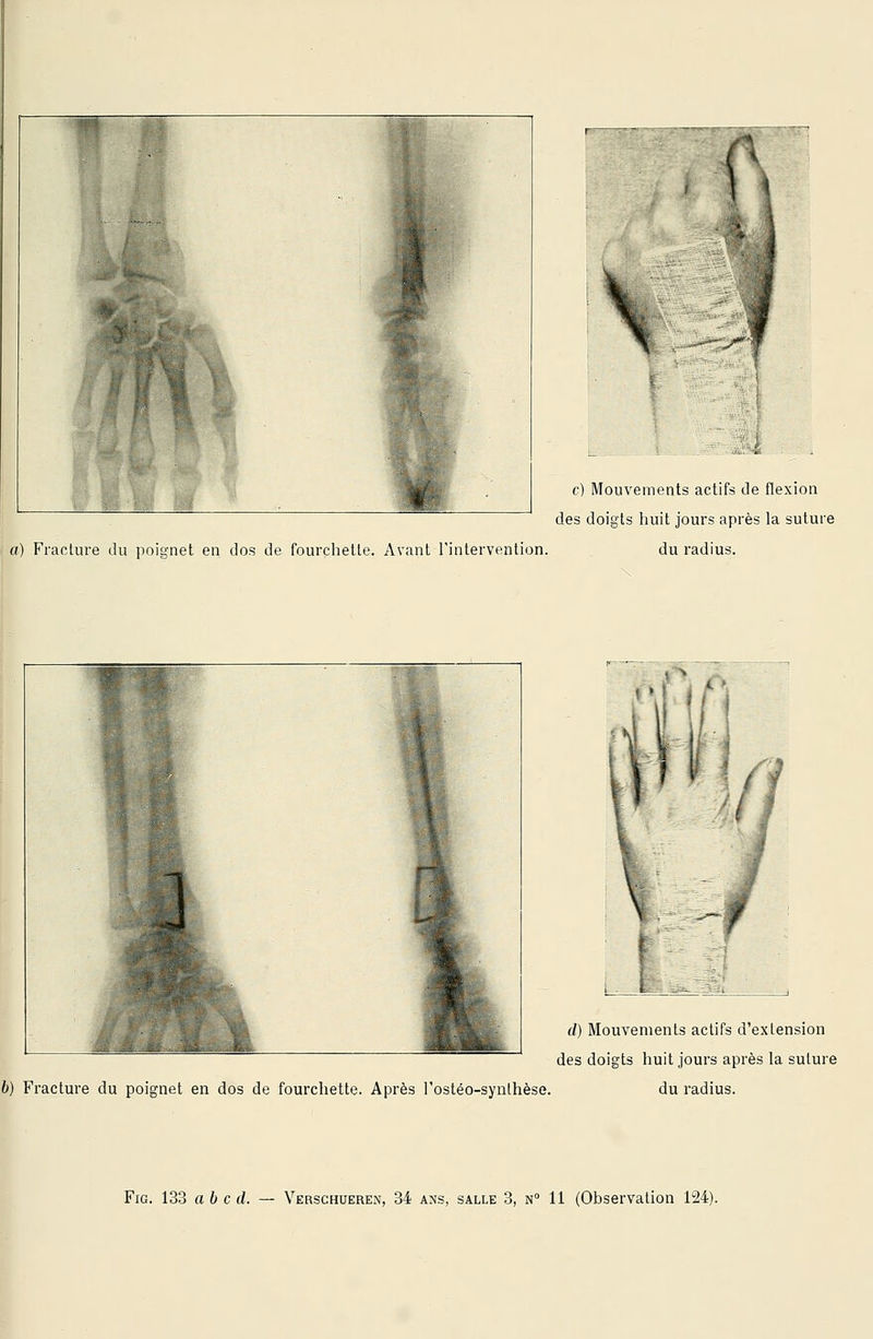 c) Mouvements actifs de flexion des doigts huit jours après la suture fl) Fracture du poignet en dos de fourchette. Avant l'intervention. du radius. i i d) Mouvements actifs d'extension des doigts huit jours après la suture 6) Fracture du poignet en dos de fourchette. Après l'ostéo-synthèse. du radius.