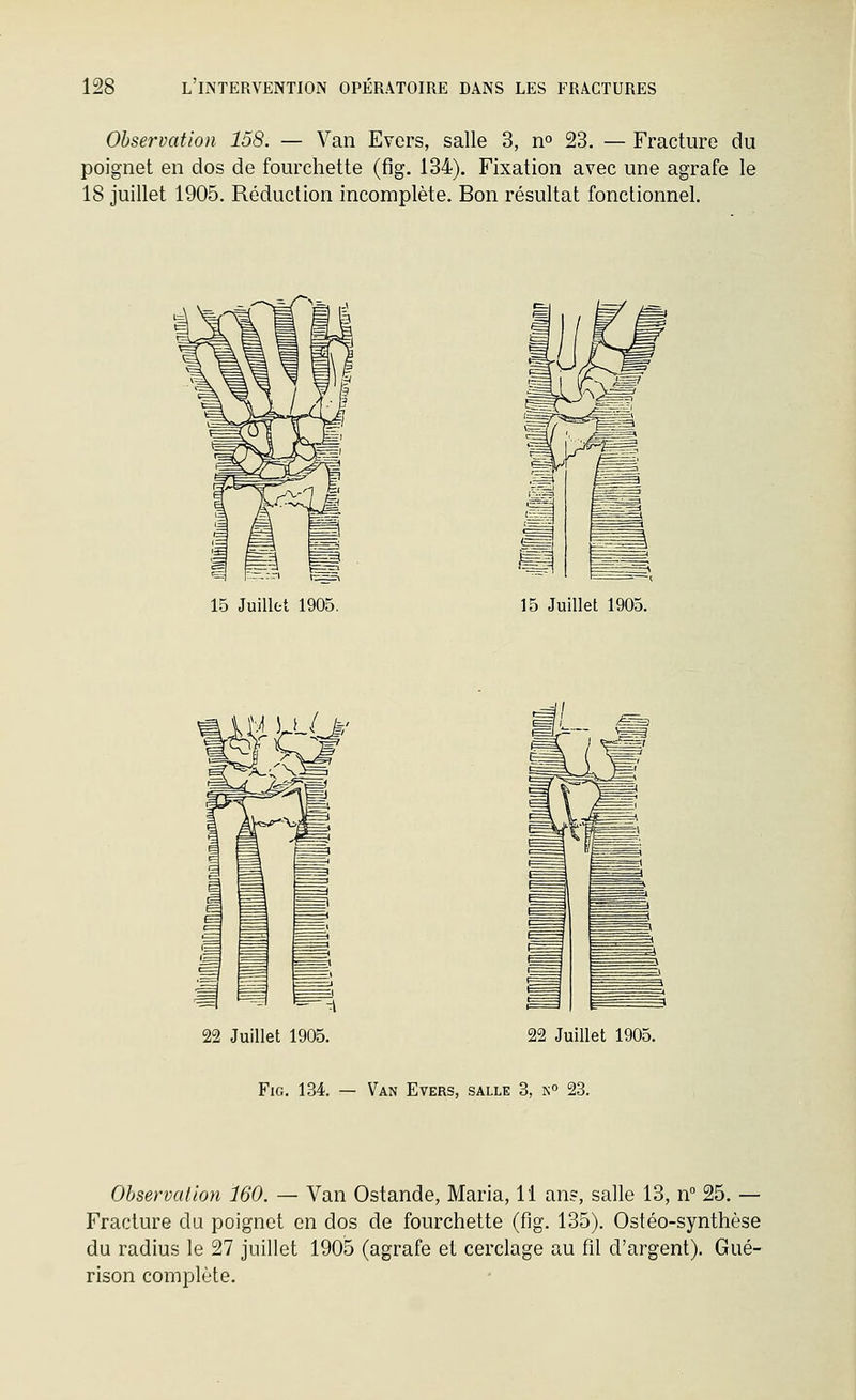 Observation 158. — Van Evers, salle 3, n° 23. — Fracture du poignet en dos de fourchette (fig. 134). Fixation avec une agrafe le 18 juillet 1905. Réduction incomplète. Bon résultat fonctionnel. 15 Juillet 1905. 15 Juillet 1905. 22 Juillet 1905. 22 Juillet 1905. FiG. 134. — Van Evers, salle 3, n 23. Observation 160. — Van Ostande, Maria, 11 an?, salle 13, n 25. — Fracture da poignet en dos de fourchette (fig. 135). Ostéo-synthèse du radius le 27 juillet 1905 (agrafe et cerclage au fil d'argent). Gué- rison complète.