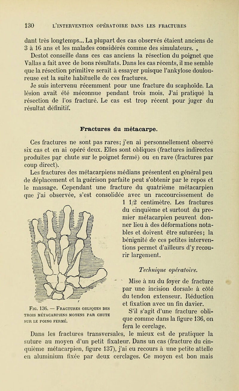 dant très longtemps... La plupart des cas observés étaient anciens de 3 à 16 ans et les malades considérés comme des simulateurs. „ Destot conseille dans ces cas anciens la résection du poignet que Vallas a fait avec de bons résultats. Dans les cas récents, il me semble que la résection primitive serait à essayer puisque l'ankylose doulou- reuse est la suite habituelle de ces fractures. Je suis intervenu récemment pour une fracture du scaphoïde. La lésion avait été méconnue pendant trois mois. J'ai pratiqué la résection de l'os fracturé. Le cas est trop récent pour juger du résultat définitif. Fractures du métacarpe. Ces fractures ne sont pas rares; j'en ai personnellement observé six cas et en ai opéré deux. Elles sont obliques (fractures indirectes produites par chute sur le poignet fermé) ou en rave (fractures par coup direct). Les fractures des métacarpiens médians présentent en général peu de déplacement et la guérison parfaite peut s'obtenir par le repos et le massage. Cependant une fracture du quatrième métacarpien que j'ai observée, s'est consolidée avec un raccourcissement de 1 1/2 centimètre. Les fractures du cinquième et surtout du pre- mier métacarpien peuvent don- ner lieu à des déformations nota- bles et doivent être suturées ; la bénignité de ces petites interven- tions permet d'ailleurs d'y recou- rir largement. Technique opératoire. - Mise à nu du foyer de fracture par une incision dorsale à côté du tendon extenseur. Réduction et fixation avec un fm davier. S'il s'agit d'une fracture obli- que comme dans la figure 136, on fera le cerclage. Dans les fractures transversales, le mieux est de pratiquer la suture au moyen d'un petit fixateur. Dans un cas (fracture du cin- quième métacarpien, figure 137), j'ai eu recours à une petite attelle en aluminium fixée par deux cerclages. Ce moyen est bon mais FiG. 136. — Fractures obliques des TROIS MÉTACARPIENS MOYENS PAR CHUTE SUR LE POING FERMÉ.