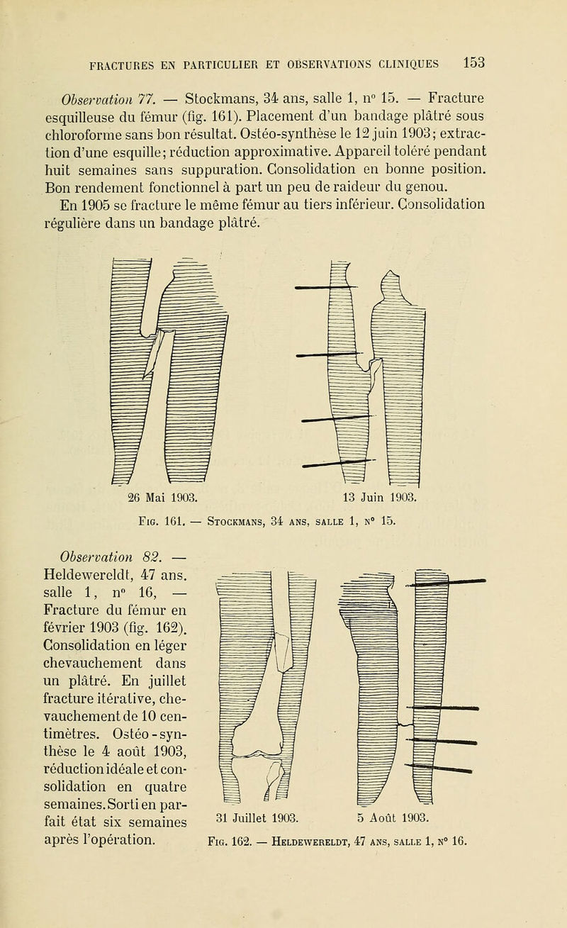 Observation 77. — Stockmans, 34 ans, salle 1, n° 15. — Fracture esquilleuse du fémur (fig. 161). Placement d'un bandage plâtré sous chloroforme sans bon résultat. Ostéo-synthèse le 12 jain 1903; extrac- tion d'une esquille; réduction approximative. Appareil toléré pendant huit semaines sans suppuration. Consolidation en bonne position. Bon rendement fonctionnel à part un peu de raideur du genou. En 1905 se fracture le même fémur au tiers inférieur. Consolidation régulière dans un bandage plâtré. 26 Mai 1903. 13 Juin 1903. FiG. 161, — Stockmans, 34 ans, salle 1, n 15, Observation 82. — Heldewereldt, 47 ans. salle 1, n° 16, — Fracture du fémur en février 1903 (fig. 162). Consolidation en léger chevauchement dans un plâtré. En juillet fracture itérative, che- vauchement de 10 cen- timètres. Ostéo - syn- thèse le 4 août 1903, réduction idéale et con- solidation en quatre semaines. Sorti en par- fait état six semaines 31 Juillet 1903. 5 Août 1903.