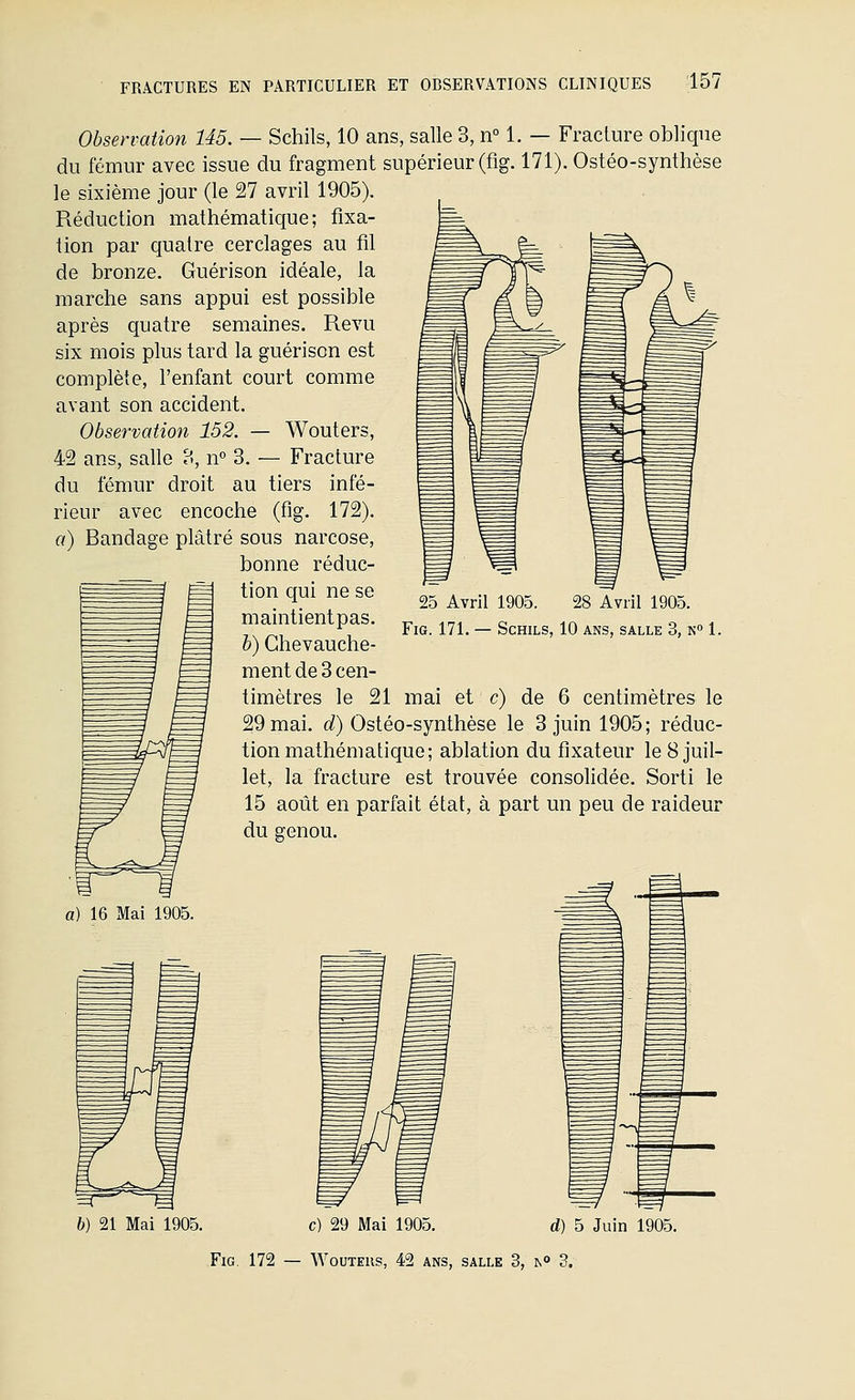 Observation 145. — Schils, 10 ans, salle 3, n° 1. — Fracture oblique du fémur avec issue du fragment supérieur (fig. 171). Ostéo-synthèse le sixième jour (le 27 avril 1905). Réduction mathématique; fixa- tion par quatre cerclages au fil de bronze. Guérison idéale, la marche sans appui est possible après quatre semaines. Revu six mois plus tard la guérison est complète, l'enfant court comme avant son accident. Observation 152. — Wouters, 42 ans, salle 3, n° 3. — Fracture du fémur droit au tiers infé- rieur avec encoche (fig. 172). a) Bandage plâtré sous narcose, bonne réduc- tion qui ne se maintient pas. b) Chevauche- ment de 3 cen- timètres le 21 mai et c) de 6 centimètres le 29 mai. d) Ostéo-synthèse le 3 juin 1905; réduc- tion mathématique; ablation du fixateur le 8 juil- let, la fracture est trouvée consolidée. Sorti le 15 août en parfait état, à part un peu de raideur du genou. a) 16 Mai 1905. 25 Avril 1905. 28 Avril 1905. Fig. 171. — Schils, 10 ans, salle 3, n 1. b) 21 Mai 1905. c) 29 Mai 1905. d) 5 Juin 1905.