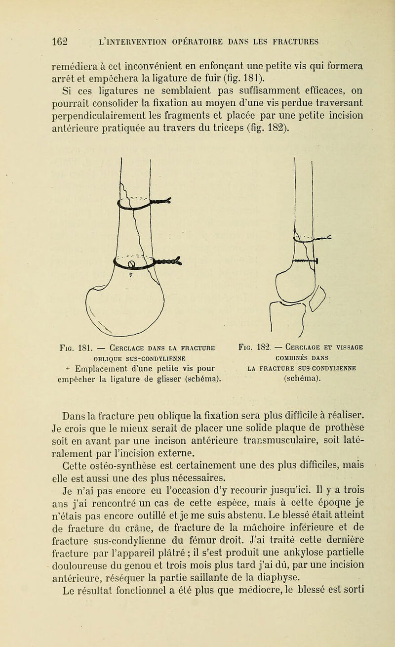 remédiera à cet inconvénient en enfonçant une petite vis qui formera arrêt et empêchera la ligature de fuir (fig. 181). Si ces ligatures ne semblaient pas suffisamment efficaces, on pourrait consolider la fixation au moyen d'une vis perdue traversant perpendiculairement les fragments et placée par une petite incision antérieure pratiquée au travers du triceps (fig. 182). Fig. 181. — Cerclage dans la fracture oblique sus-condylienne + Emplacement d'une petite vis pour empêcher la ligature de glisser (schéma). Fig. 182, — Cerclage et vissage combinés dans la fracture sus condylienne (schéma). Dans la fracture peu oblique la fixation sera plus difficile à réaliser. Je crois que le mieux serait de placer une solide plaque de prothèse soit en avant par une incison antérieure transmusculaire, soit laté- ralement par l'incision externe. Cette ostéo-synthèse est certainement une des plus difficiles, mais elle est aussi une des plus nécessaires. Je n'ai pas encore eu l'occasion d'y recourir jusqu'ici. Il y a trois ans j'ai rencontré un cas de cette espèce, mais à cette époque je n'étais pas encore outillé et je me suis abstenu. Le blessé était atteint de fracture du crâne, de fracture de la mâchoire inférieure et de fracture sus-condylienne du fémur droit. J'ai traité cette dernière fracture par l'appareil plâtré ; il s'est produit une ankylose partielle douloureuse du genou et trois mois plus tard j'ai dû, par une incision antérieure, réséquer la partie saillante de la diaphyse. Le résultat fonctionnel a été plus que médiocre, le blessé est sorti