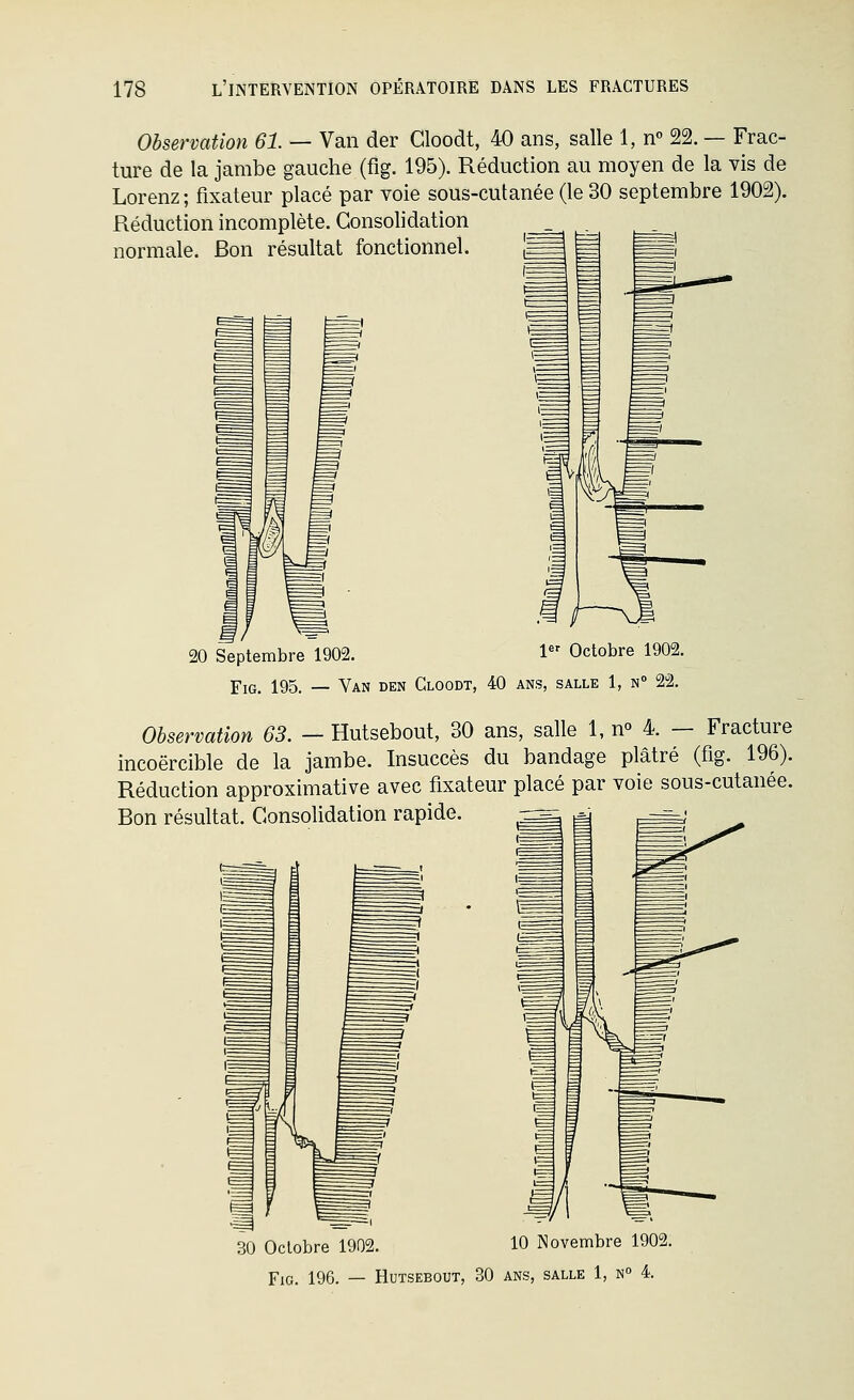 Observation 61. — Van der Cloodt, 40 ans, salle 1, n 22. — Frac- ture de la jambe gauche (fig. 195). Réduction au moyen de la vis de Lorenz; fixateur placé par voie sous-cutanée (le 30 septembre 1902). Réduction incomplète. Consolidation normale. Bon résultat fonctionnel. 20 Septembre 1902. 1 Octobre 1902. Fig. 195. — Van den Cloodt, 40 ans, salle 1, n° 22. Observation 63. - Hutsebout, 30 ans, salle 1, n» 4. — Fracture incoercible de la jambe. Insuccès du bandage plâtré (fig. 196). Réduction approximative avec fixateur placé par voie sous-cutanée. Bon résultat. Consolidation rapide. — 30 Octobre 1902. 10 Novembre 1902. FiG. 196. — Hutsebout, 30 ans, salle 1, n 4.