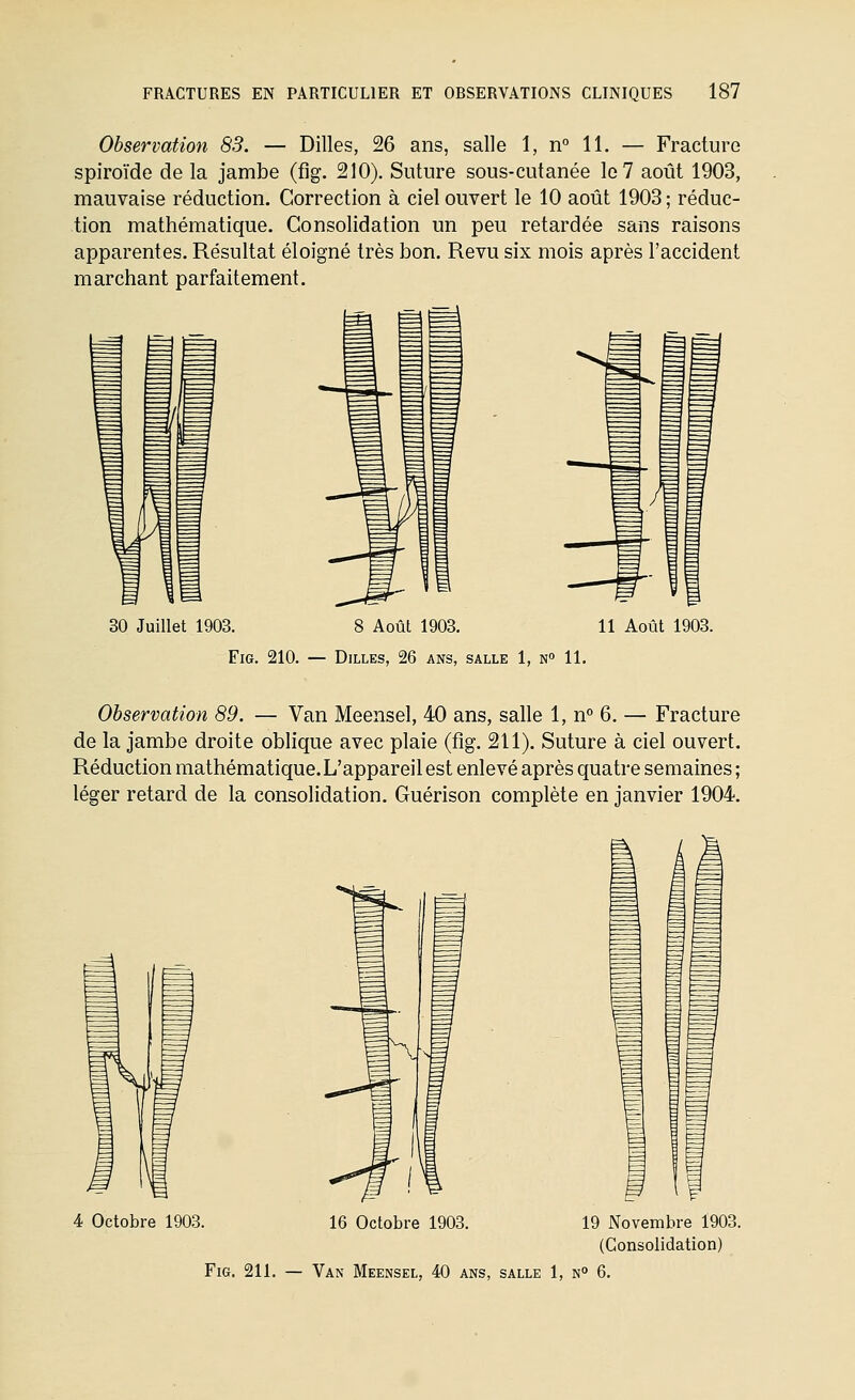 Observation 83. — Dilles, 26 ans, salle 1, n° 11. — Fracture spiroïde de la jambe (fig. 210). Suture sous-cutanée le 7 août 1903, mauvaise réduction. Correction à ciel ouvert le 10 août 1903 ; réduc- tion mathématique. Consolidation un peu retardée sans raisons apparentes. Résultat éloigné très bon. Revu six mois après l'accident marchant parfaitement. 30 Juillet 1903. 8 Août 1903. 11 Août 1903. Fig. 210. — Dilles, 26 ans, salle 1, n» 11. Observation 89. — Van Meensel, 40 ans, salle 1, n° 6. — Fracture de la jambe droite oblique avec plaie (fig. 211). Suture à ciel ouvert. Réduction mathématique. L'appareil est enlevé après quatre semaines ; léger retard de la consolidation. Guérison complète en janvier 1904. 4 Octobre 1903. 16 Octobre 1903. 19 Novembre 1903. (Consolidation)