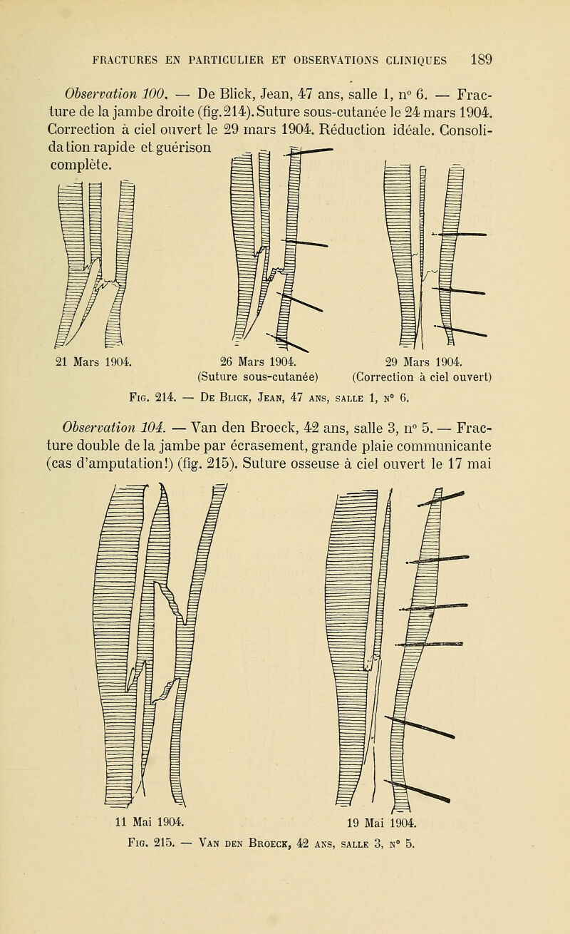 Observation 100. — De Blick, Jean, 47 ans, salle 1, n 6. — Frac- ture de la jambe droite (fig.214). Suture sous-cutanée le 24 mars 1904. Correction à ciel ouvert le 29 mars 1904. Réduction idéale. Consoli- dation rapide etguérison complète. 21 Mars 1904. 26 Mars 1904. 29 Mars 1904. (Suture sous-cutanée) (Correction à ciel ouvert) Fig. 214. — De Blick, Jean, 47 ans, salle 1, n° 6. Observation 104. — Van den Broeck, 42 ans, salle 3, n° 5. — Frac- ture double de la jambe par écrasement, grande plaie communicante (cas d'amputation!) (fig. 215). Suture osseuse à ciel ouvert le 17 mai 11 Mai 1904. 19 Mai 1904. Fig. 215, — Van den Broeck, 42 ans, salle 3, n 5.