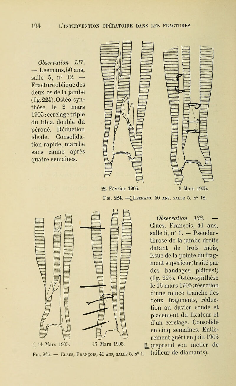 Observation 137. — Leemans,50 ans, salle 5, n° 12. — Fracture oblique des deux os de la jambe (fig.224).Ostéo-syn- thèse le 2 mars 1905 : cerclage triple du tibia, double du péroné. Réduction idéale. Consolida- tion rapide, marche sans canne après quatre semaines. 22 Février 1905. 3 Mars 1905. FiG. 224. —^Leemans, 50 ans, salle 5, n° 12. L 14 Mars 1905. 17 Mars 1905. FiG. 225. — Claes, François, 41 ans, salle 5, n° 1 Observation 138. — Claes, François, 41 ans, salle 5, n° 1. — Pseudar- throse de la jambe droite datant de trois mois, issue de la pointe du frag- ment supérieur(traitépar des bandages plâtrés!) (fig. 225). Ostéo-synthèse le 16 mars 1905;résection d'une mince tranche des deux fragments, réduc- tion au davier coudé et placement du fixateur et d'un cerclage. Consolidé en cinq semaines. Entiè- rement guéri en juin 1905 1^ (reprend son métier de tailleur de diamants).