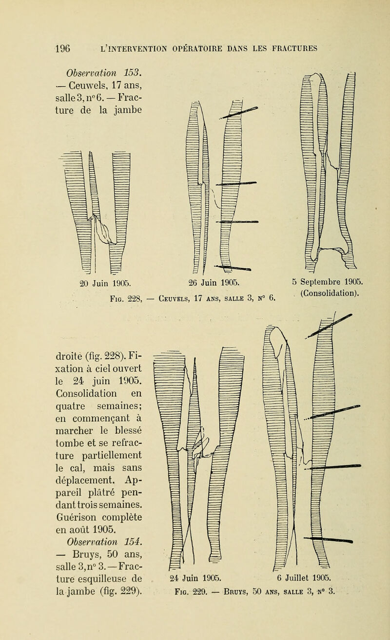 Observation 153. — Ceuwels, 17 ans, salleS^n^e. —Frac- ture de la jambe 20 Juin 1905. 26 Juin 1905. FiG. 228, — Ceuvels, 17 ans, salle 3, n° 6. droite (fig. 228). Fi- xation à ciel ouvert le 24 juin 1905. Consolidation en quatre semaines; en commençant à marcher le blessé tombe et se refrac- ture partiellement le cal, mais sans déplacement. Ap- pareil plâtré pen- dant trois semaines. Guérison complète en août 1905. Observation 154. — Bruys, 50 ans, salle 3, n° 3. —Frac- ture esquilleuse de 5 Septembre 1905. . (Consolidation). 24 Juin 1905. 6 Juillet 1905.