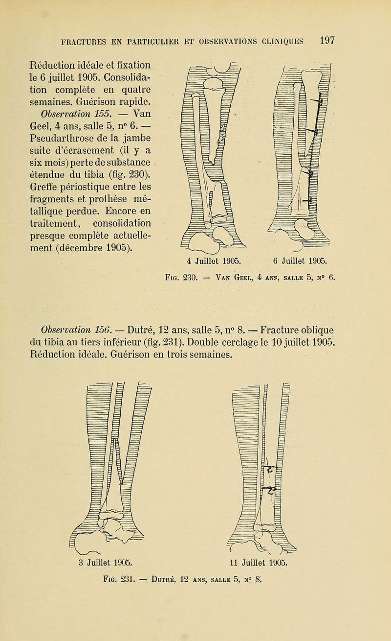 Réduction idéale et fixation le 6 juillet 1905. Consolida- tion complète en quatre semaines. Guérison rapide. Observation 155. — Van Geel, 4 ans, salle 5, n 6. — Pseudarthrose de la jambe suite d'écrasement (il y a six mois) perte de substance étendue du tibia (fig. 230). Greffe périostique entre les fragments et prothèse mé- tallique perdue. Encore en traitement, consolidation presque complète actuelle- ment (décembre 1905). 4 Juillet 1905. 6 Juillet 1905. EiG. 230, — Van Geel, 4 ans, salle 5, n° 6. Observation 156. — Dutré, 12 ans, salle 5, n° 8. — Fracture oblique du tibia au tiers inférieur (fig. 231). Double cerclage le 10 juillet 1905. Réduction idéale. Guérison en trois semaines. 3 Juillet 1905. 11 Juillet 1905.