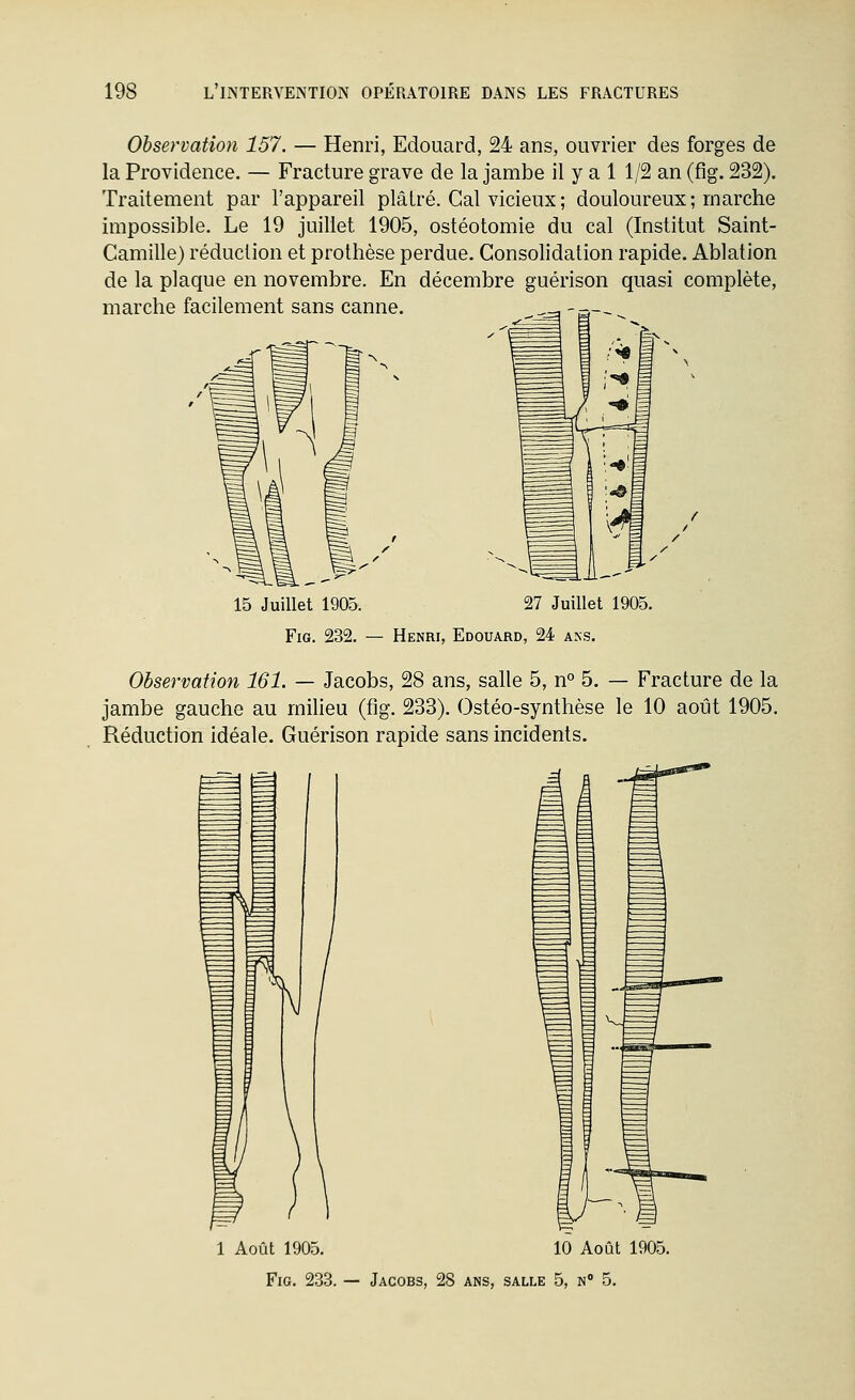 Observation 157. — Henri, Edouard, 24 ans, ouvrier des forges de la Providence. — Fracture grave de la jambe il y a 1 1/2 an (fig. 232). Traitement par l'appareil plâtré. Cal vicieux ; douloureux; marche impossible. Le 19 juillet 1905, ostéotomie du cal (Institut Saint- Camille) réduction et prothèse perdue. Consolidation rapide. Ablation de la plaque en novembre. En décembre guérison quasi complète, marche facilement sans canne. ^■^. 15 Juillet 1905. 27 Juillet 1905. Fig. 232. — Henri, Edouard, 24 aks. Observation 161. — Jacobs, 28 ans, salle 5, n° 5. — Fracture de la jambe gauche au milieu (fig. 233). Ostéo-synthèse le 10 août 1905. Réduction idéale. Guérison rapide sans incidents. 1 Août 1905. Fig. 233. — Jacobs, 10 Août 1905. ANS, SALLE 5, N 5.