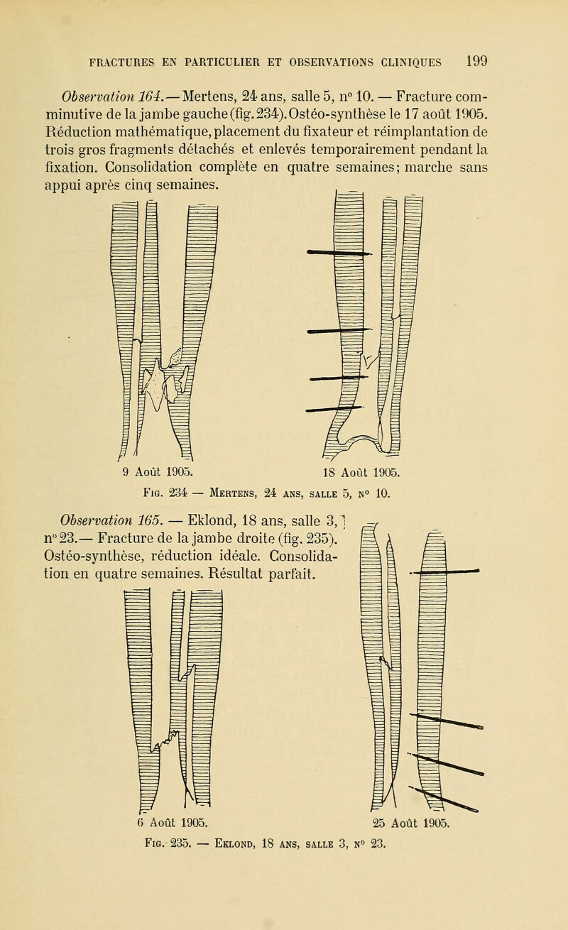 Observation 164.—Mertens, 24 ans, salle 5, n 10. — Fracture com- minutive de la jambe gauche (fig, 234). Ostéo-syntlièse le 17 août 1905. Réduction mathématique, placement du fixateur et réimplantation de trois gros fragments détachés et enlevés temporairement pendant la fixation. Consolidation complète en quatre semaines; marche sans appui après cinq semaines. 9 Août 1905. 18 Août 1905. Fig. 234 — Mertens, 24 ans, salle 5, n° 10. Observation 165. — Eklond, 18 ans, salle 3,1 n°23.— Fracture de la jambe droite (fig. 235). Ostéo-synthèse, réduction idéale. Consolida- tion en quatre semaines. Résultat parfait. 6 Août 1905. 25 Août 1905.