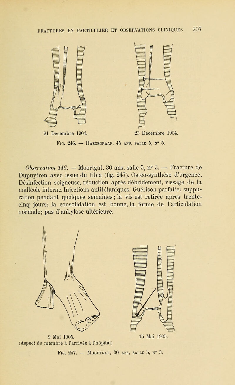 21 Décembre 1904. 23 Décembre 1904, FiG. 246. — Haekegraaf, 45 ans, salle 5, n° 5. Observation 146. — Moortgat, 30 ans, salle 5, n° 3. — Fracture de Dupuytren avec issue du tibia (fig. 247). Ostéo-synthèse d'urgence. Désinfection soigneuse, réduction après débridement, vissage de la malléole interne.Injections antitétaniques. Guérison parfaite; suppu- ration pendant quelques semaines ; la vis est retirée après trente- cinq jours; la consolidation est bonne, la forme de l'articulation normale; pas d'ankylose ultérieure. 15 Mai 1905. Fig. 247. — Moortgat, 30 ans, salle 5, n 3. 9 Mai 1905. (Aspect du membre à l'arrivée à l'hôpital)