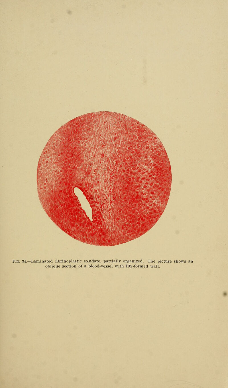Fig. 34.—Laminated fibrinoplastic exudate, partially organized. The picture shows an oblique section of a blood-vessel with illy-formed wall.