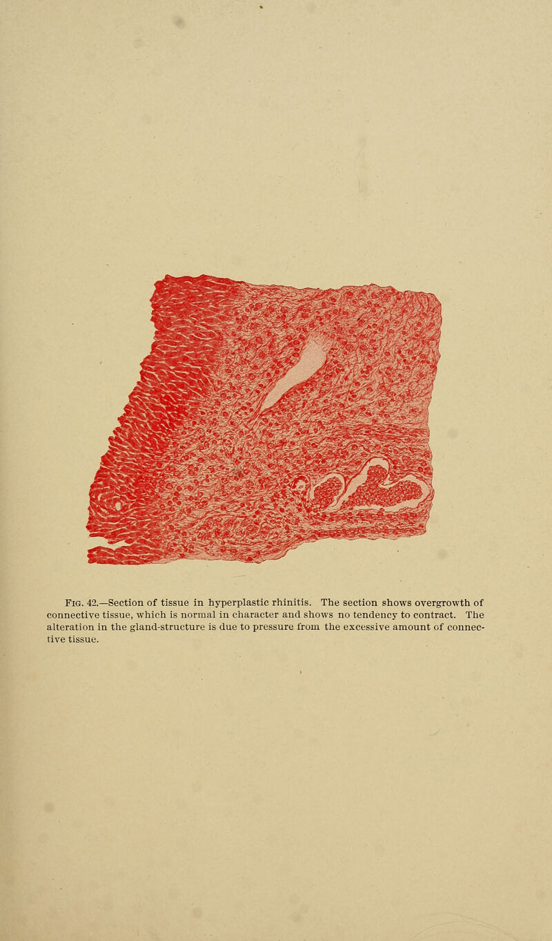 Fig. 42.—Section of tissue in hyperplastic rhinitis. The section shows overgrowth of connective tissue, which is normal in character and shows no tendency to contract. The alteration in the gland-structure is due to pressure from the excessive amount of connec- tive tissue.
