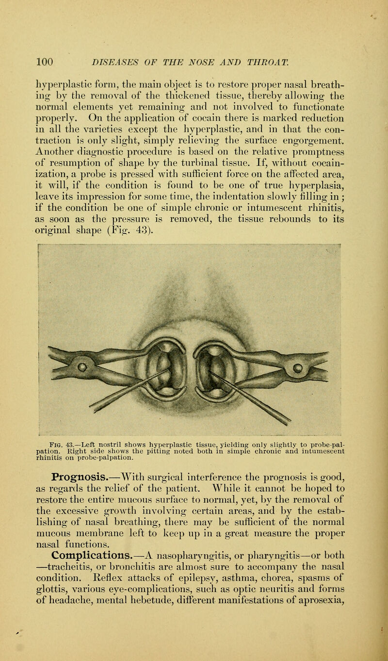 hyperplastic form, the main object is to restore proper nasal breath- ing by the removal of the thickened tissue, thereby allowing the normal elements yet remaining and not involved to functionate properly. On the application of cocain there is marked reduction in all the varieties except the hyperplastic, and in that the con- traction is only slight, simply relieving the surface engorgement. Another diagnostic procedure is based on the relative promptness of resumption of shape by the turbinal tissue. If, without cocain- ization, a probe is pressed with sufficient force on the affected area, it will, if the condition is found to be one of true hyperplasia, leave its impression for some time, the indentation slowly filling in ; if the condition be one of simple chronic or intumescent rhinitis, as soon as the pressure is removed, the tissue rebounds to its original shape (Fig. 43). Fig. 43.—Left nostril shows hyperplastic tissue, yielding only slightly to probe-pal- pation. Right side shows the pitting noted both in simple chronic and intumescent rhinitis on probe-palpation. Prognosis.—With surgical interference the prognosis is good, as regards the relief of the patient. While it cannot be hoped to restore the entire mucous surface to normal, yet, by the removal of the excessive growth involving certain areas, and by the estab- lishing of nasal breathing, there may be sufficient of the normal mucous membrane left to keep up in a great measure the proper nasal functions. Complications.—A nasopharyngitis, or pharyngitis—or both —tracheitis, or bronchitis are almost sure to accompany the nasal condition. Reflex attacks of epilepsy, asthma, chorea, spasms of glottis, various eye-complications, such as optic neuritis and forms of headache, mental hebetude, different manifestations of aprosexia,