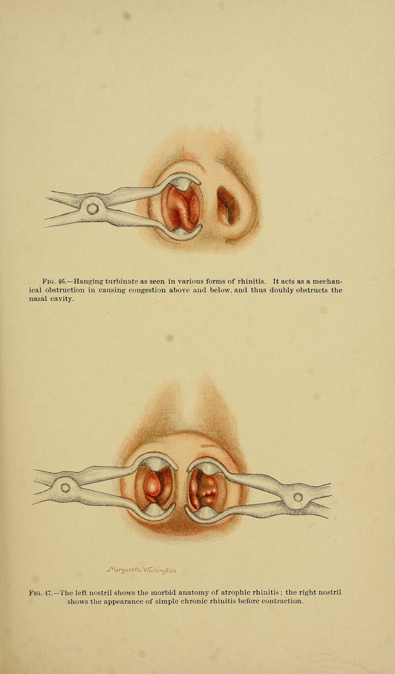 Fig. 46.—Hanging turbinate as seen in various forms of rhinitis. It acts as a mechan- ical obstruction in causing congestion above and below, and thus doubly obstructs the nasal cavity. -A\ar3are1tQWSiKiiu)tc Fig. 47. -The left nostril shows the morbid anatomy of atrophic rhinitis ; the right nostril shows the appearance of simple chronic rhinitis before contraction.