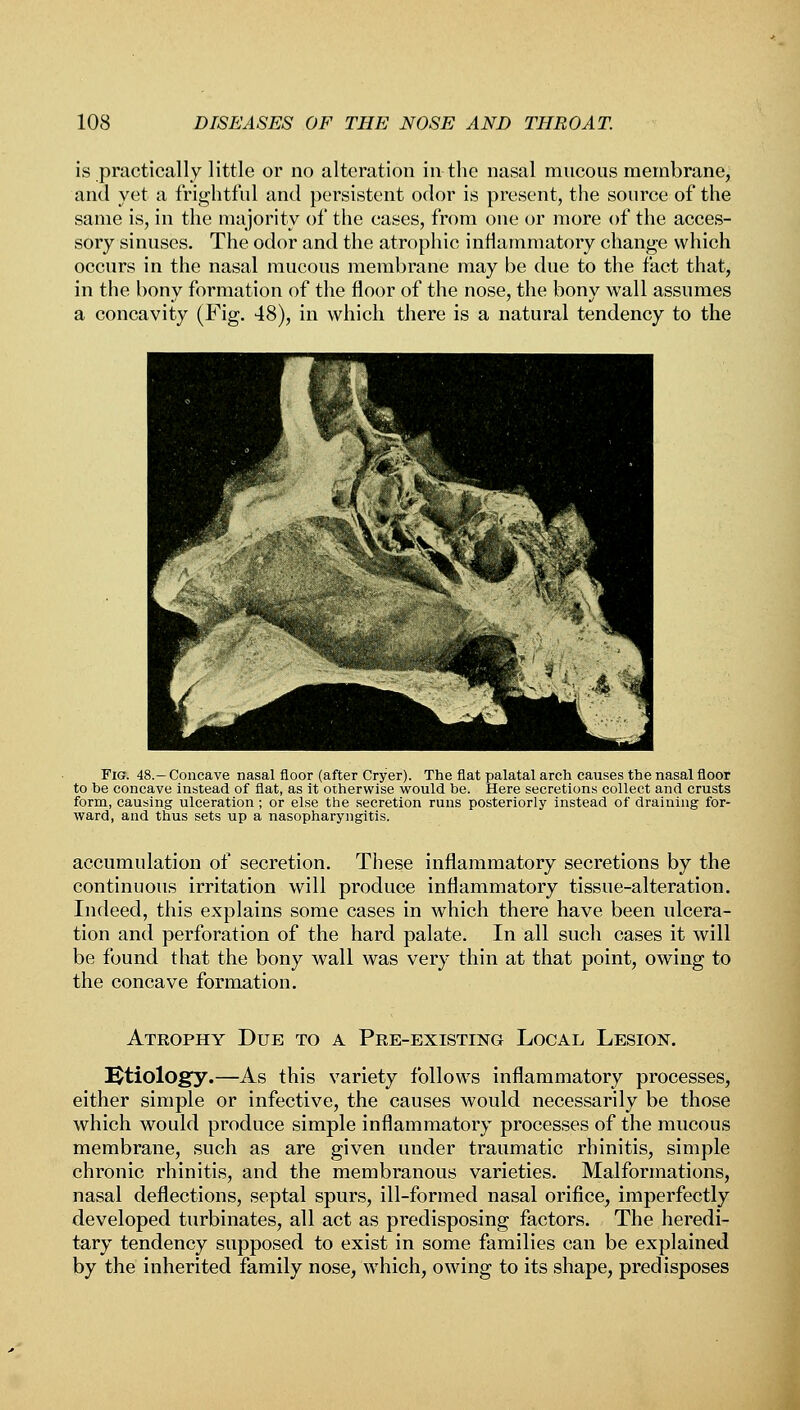 is practically little or no alteration in the nasal mucous membrane, and yet a frightful and persistent odor is present, the source of the same is, in the majority of the cases, from one or more of the acces- sory sinuses. The odor and the atrophic inflammatory change which occurs in the nasal mucous membrane may be due to the fact that, in the bony formation of the floor of the nose, the bony wall assumes a concavity (Fig. 48), in which there is a natural tendency to the Fig. 48.—Concave nasal floor (after Cryer). The flat palatal arch causes the nasal floor to be concave instead of flat, as it otherwise would be. Here secretions collect and crusts form, causing ulceration; or else the secretion runs posteriorly instead of draining for- ward, and thus sets up a nasopharyngitis. accumulation of secretion. These inflammatory secretions by the continuous irritation will produce inflammatory tissue-alteration. Indeed, this explains some cases in which there have been ulcera- tion and perforation of the hard palate. In all such cases it will be found that the bony wall was very thin at that point, owing to the concave formation. Atrophy Due to a Pre-existing Local Lesion. Etiology.—As this variety follows inflammatory processes, either simple or infective, the causes would necessarily be those which would produce simple inflammatory processes of the mucous membrane, such as are given under traumatic rhinitis, simple chronic rhinitis, and the membranous varieties. Malformations, nasal deflections, septal spurs, ill-formed nasal orifice, imperfectly developed turbinates, all act as predisposing factors. The heredi- tary tendency supposed to exist in some families can be explained by the inherited family nose, which, owing to its shape, predisposes
