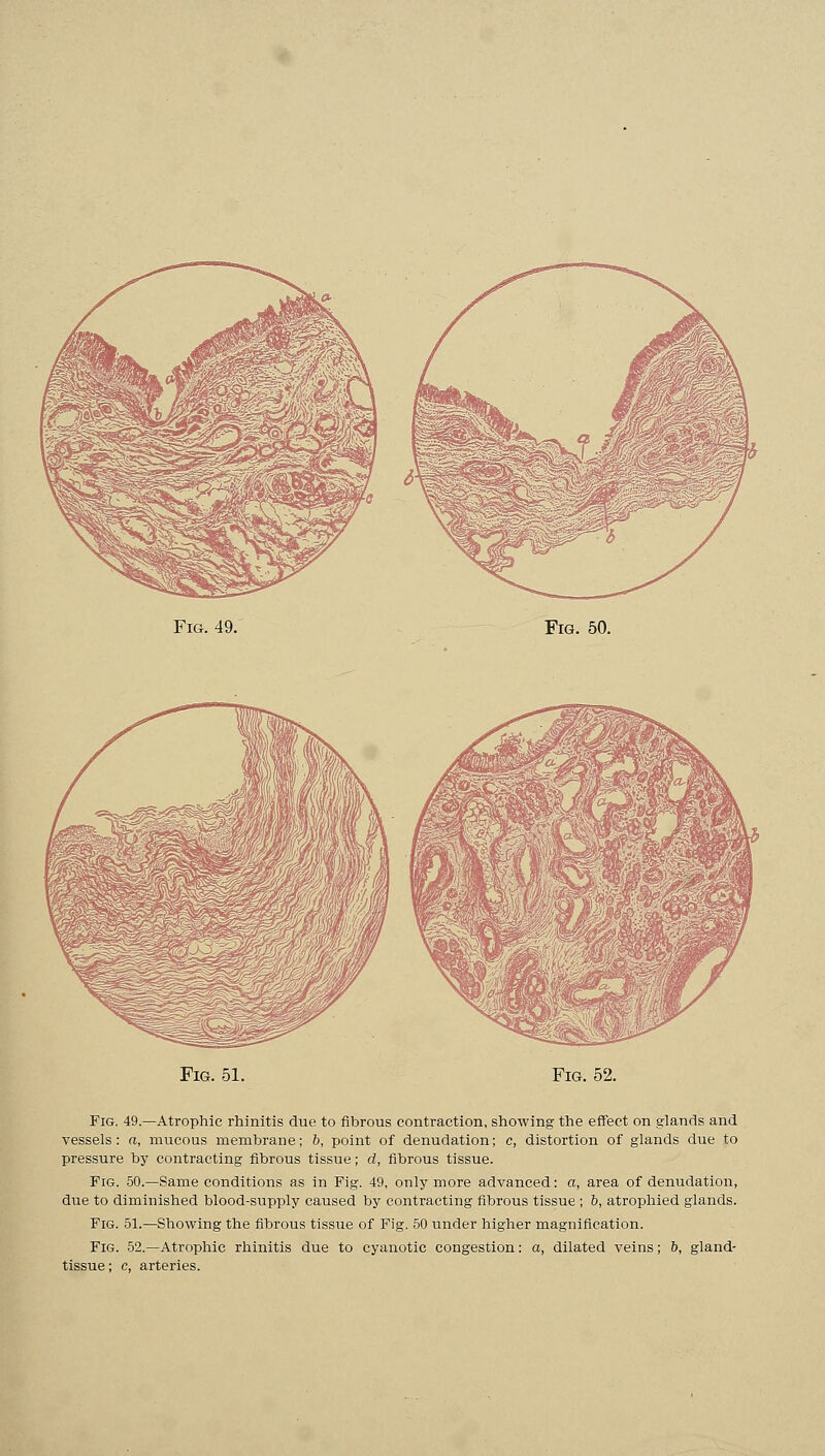 Fig. 49. Fig. 50. Fig. 51. Fig. 52. Fig. 49.—Atrophic rhinitis due to fibrous contraction, showing the effect on glands and vessels: a, mucous membrane; b, point of denudation; c, distortion of glands due to pressure by contracting fibrous tissue; d, fibrous tissue. Fig. 50.—Same conditions as in Fig. 49, only more advanced: a, area of denudation, due to diminished blood-supply caused by contracting fibrous tissue ; b, atrophied glands. Fig. 51.—Showing the fibrous tissue of Fig. 50 under higher magnification. Fig. 52.—Atrophic rhinitis due to cyanotic congestion: a, dilated veins; b, gland- tissue; c, arteries.